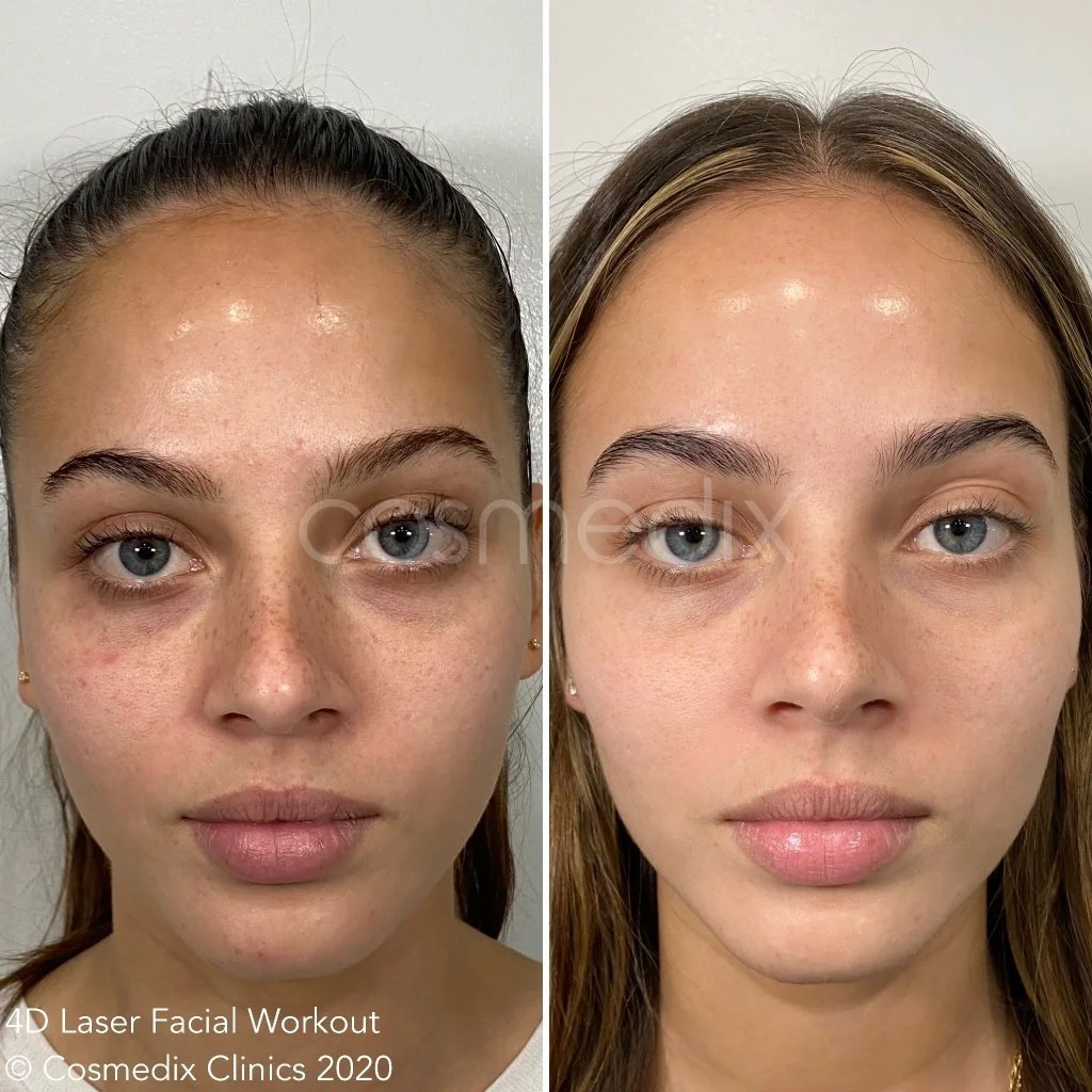 2020 4D Laser Facial -Isabelle Impala_.JPG