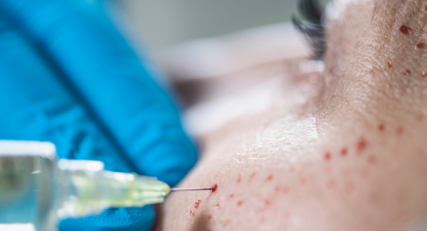 Person receiving PRP facial injection