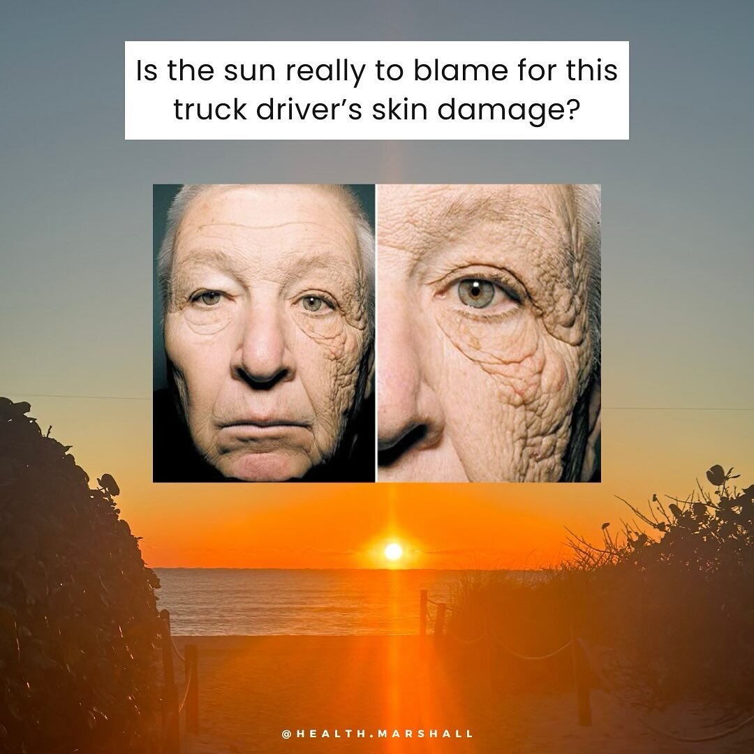 Many articles show this photo of a truck driver&rsquo;s wrinkled face to blame the sun for being toxic. That is not the case. I will elaborate below. 

A chronic form of photochemical skin damage can be seen in truck drivers and those that sit behind