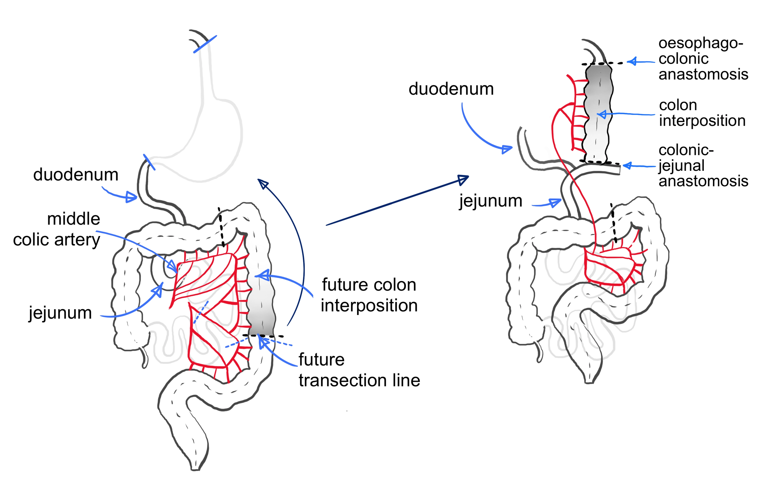 Diagram of colon surgery showing steps including colorectal anastomosis, colon interposition, and surgical connections between the duodenum, jejunum, and colon.