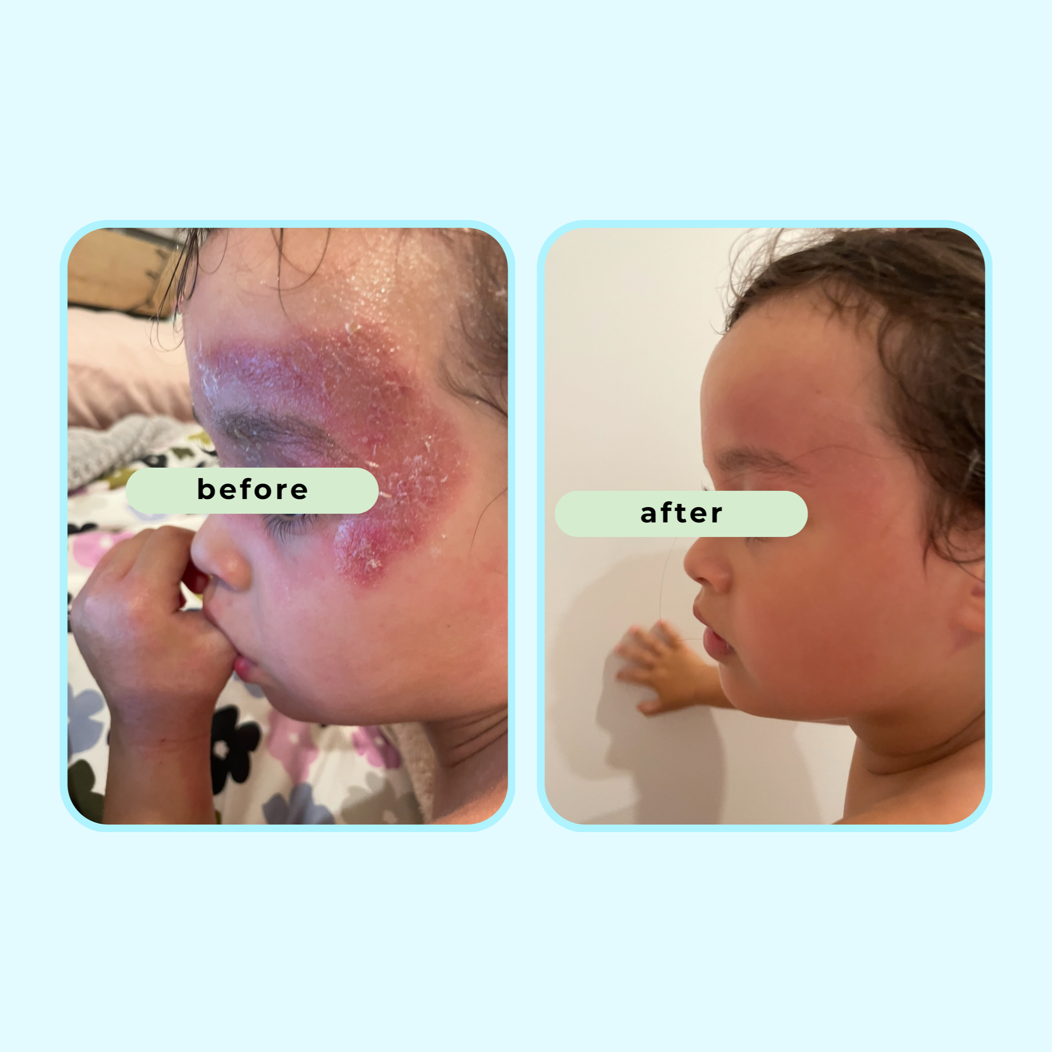 Child’s skin appearance before and after using a soothing natural eczema balm to support calm, comfortable skin