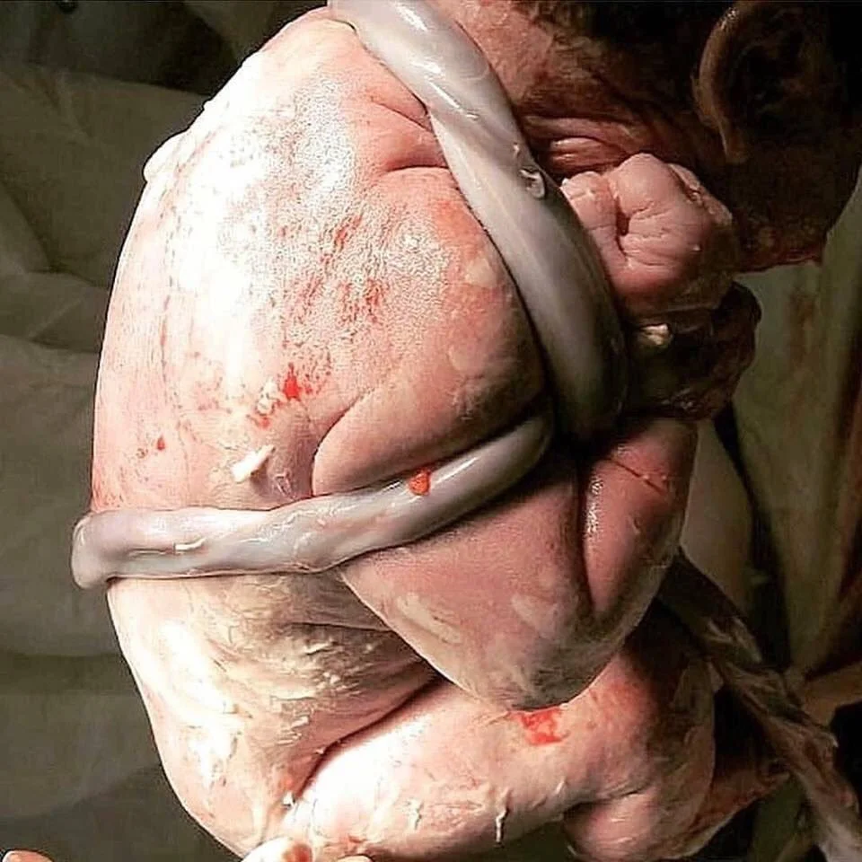 Untangling the Fear around Nuchal Cords