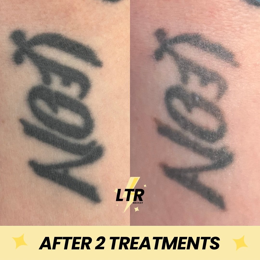 Only 2 treatments on this and we&rsquo;re already seeing some skin peeking through! 🫣 

SERVICE: Laser Tattoo Removal
PRICE: From $50 per session 
DISCOMFORT: Moderate
DOWNTIME: 7 days 

WHAT IS LASER TATTOO REMOVAL? 
A medical procedure that uses c