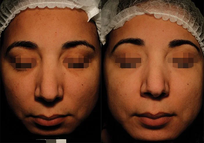 before and after universkin