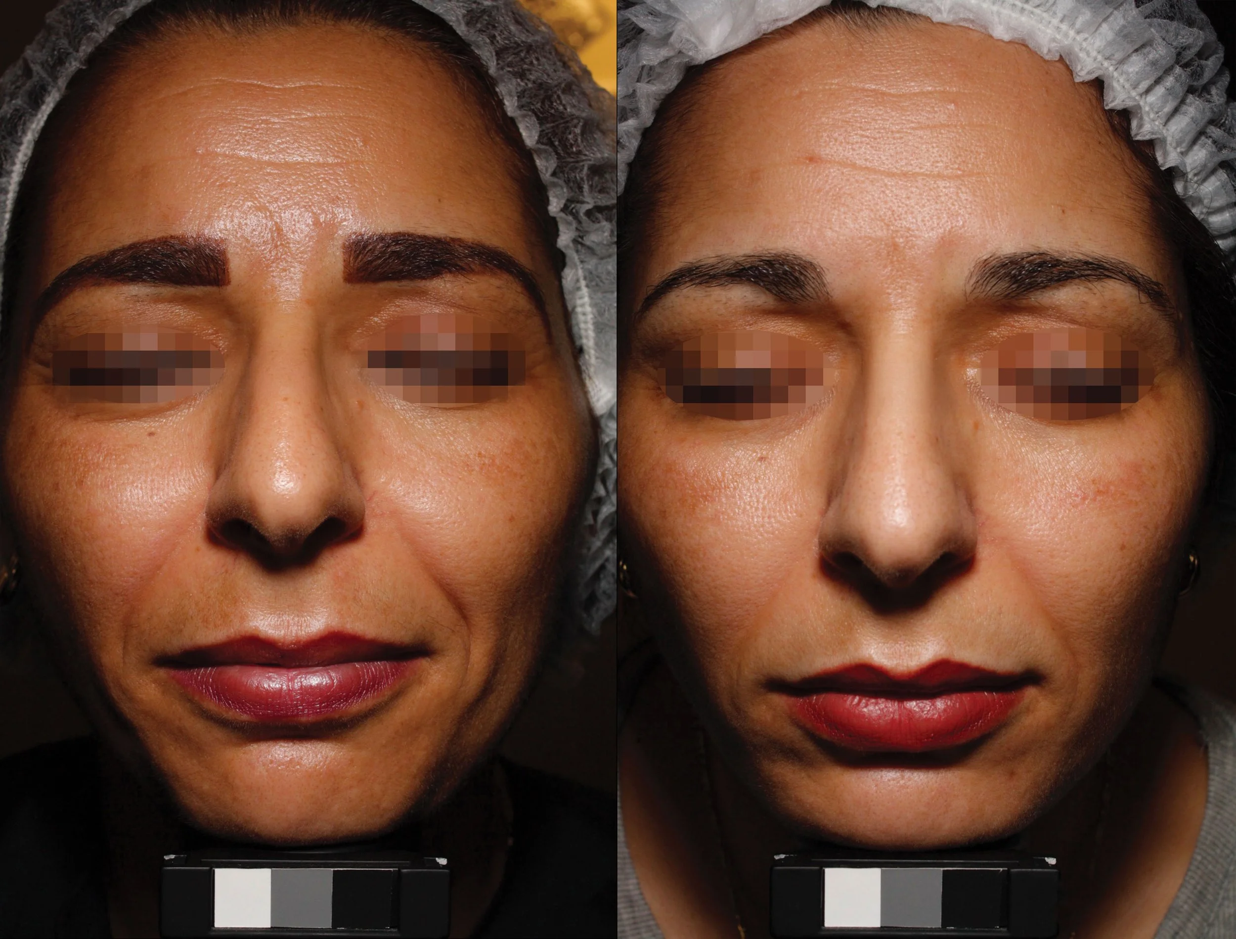 before and after universkin use 
