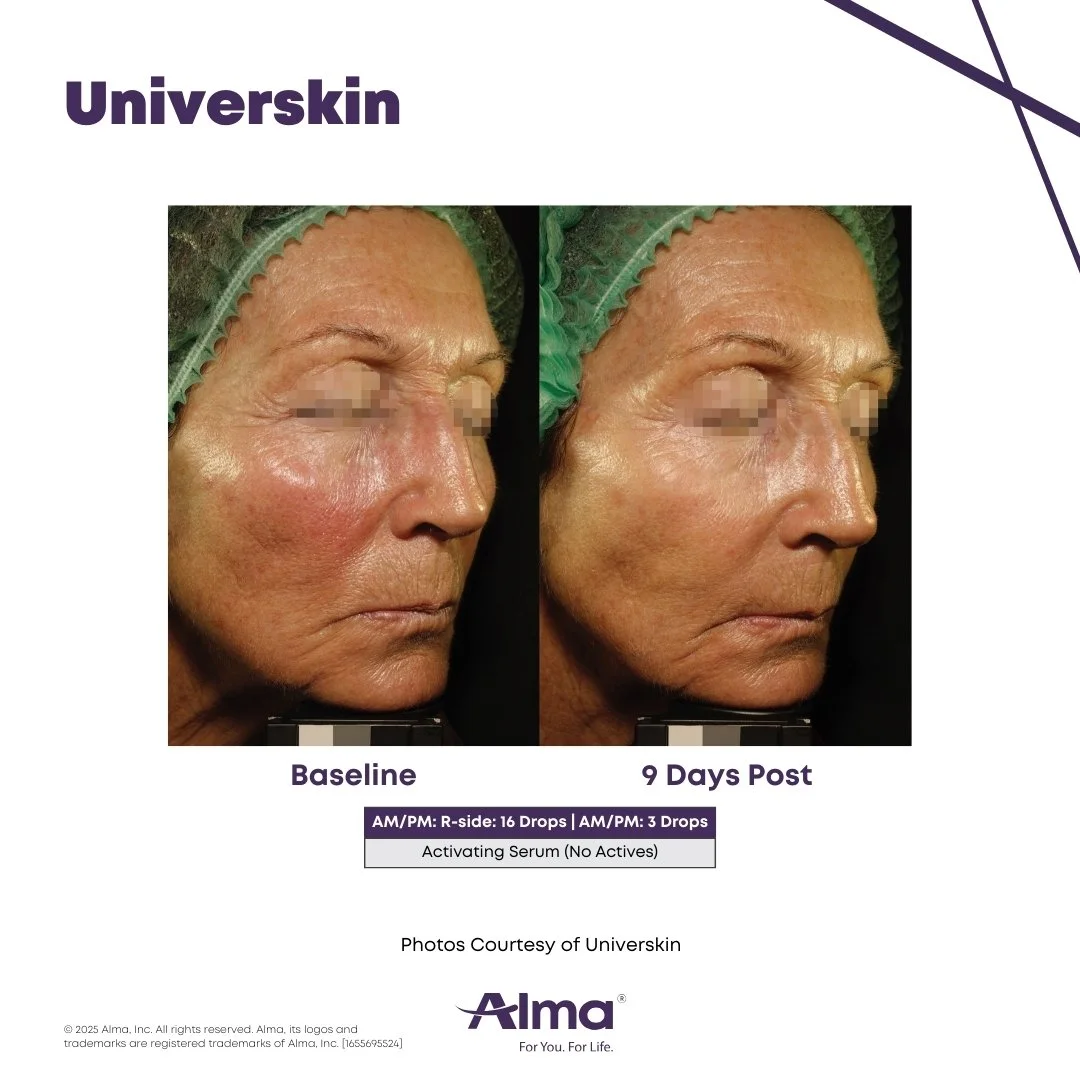 Before and after image showing a woman who utilized universkin