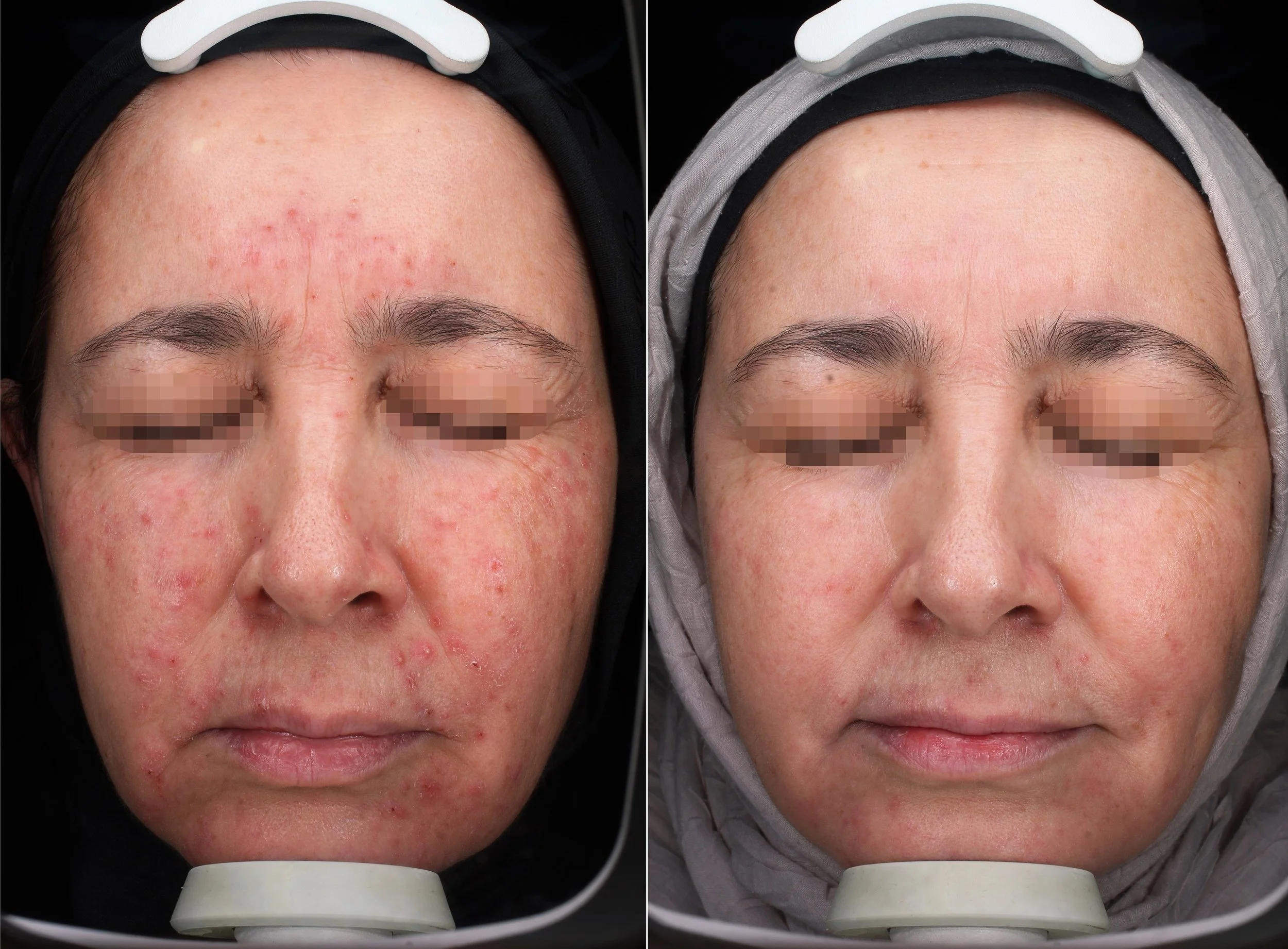 Before and after universkin