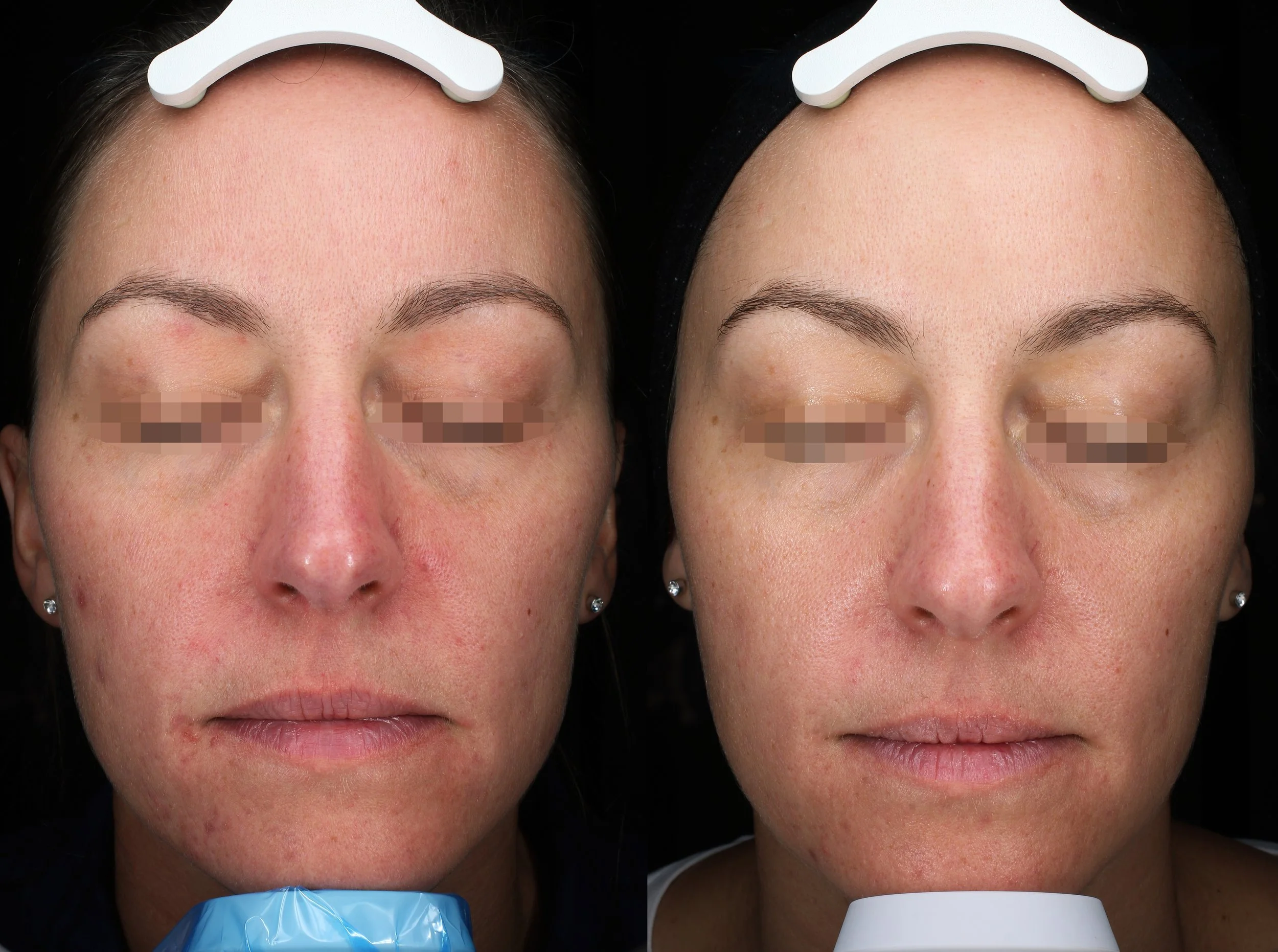 Before and after using universkin