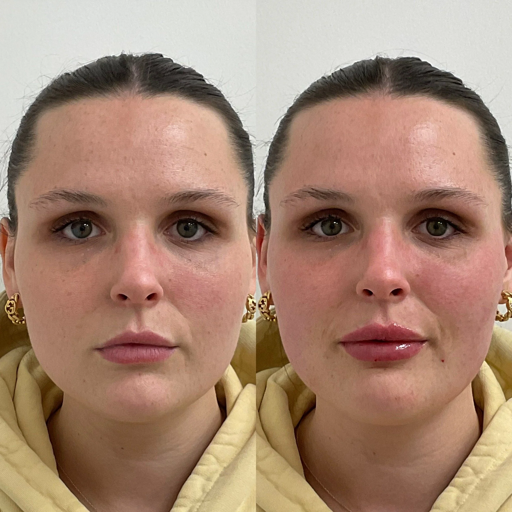 Close-up of a person's forehead, eyes, and upper cheeks, with a woman wearing gold jewelry and a light yellow hoodie visible at the bottom.