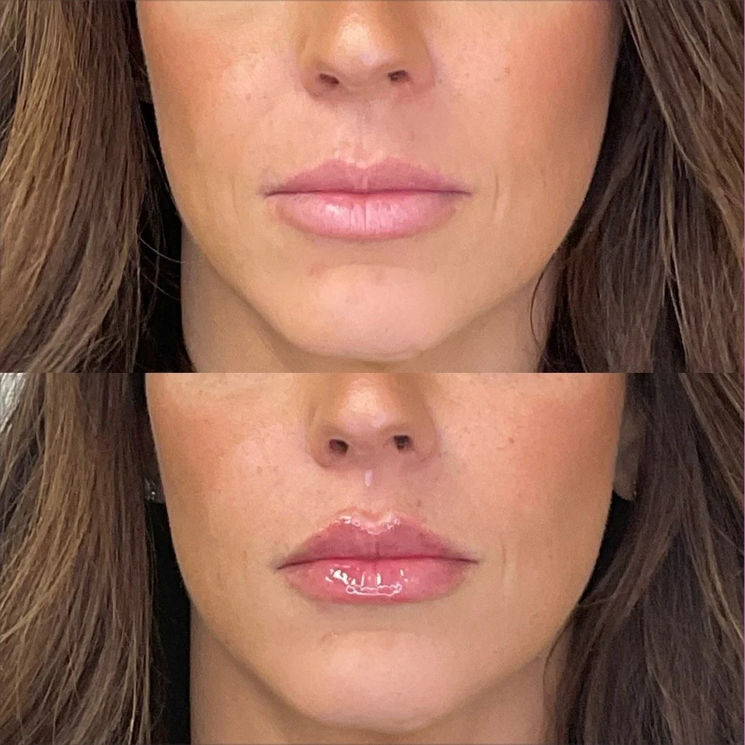 Lip filler