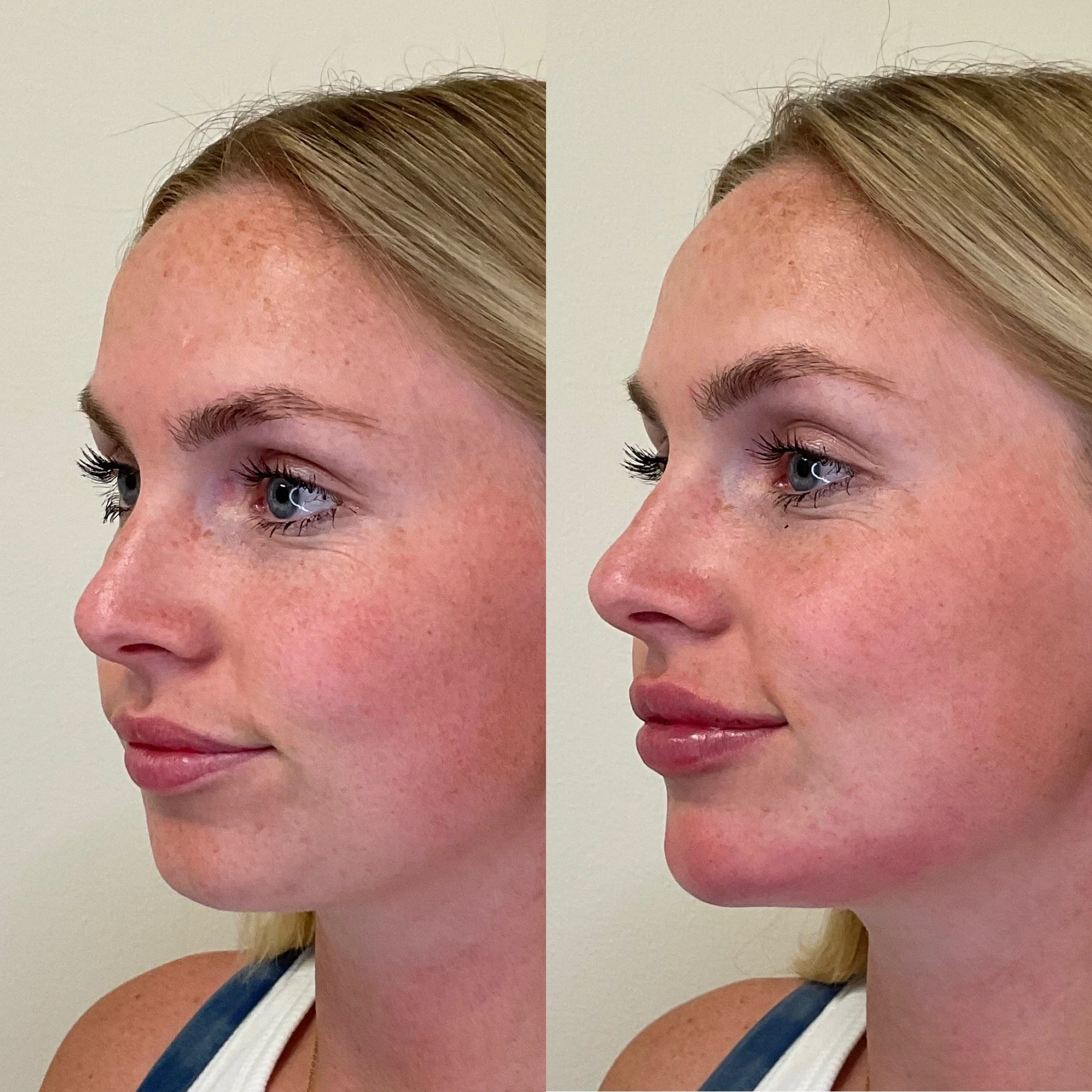 Close-up of a woman's face showing the forehead, eyebrows, and eyes before and after a cosmetic procedure, with clear skin and makeup on eyelashes.