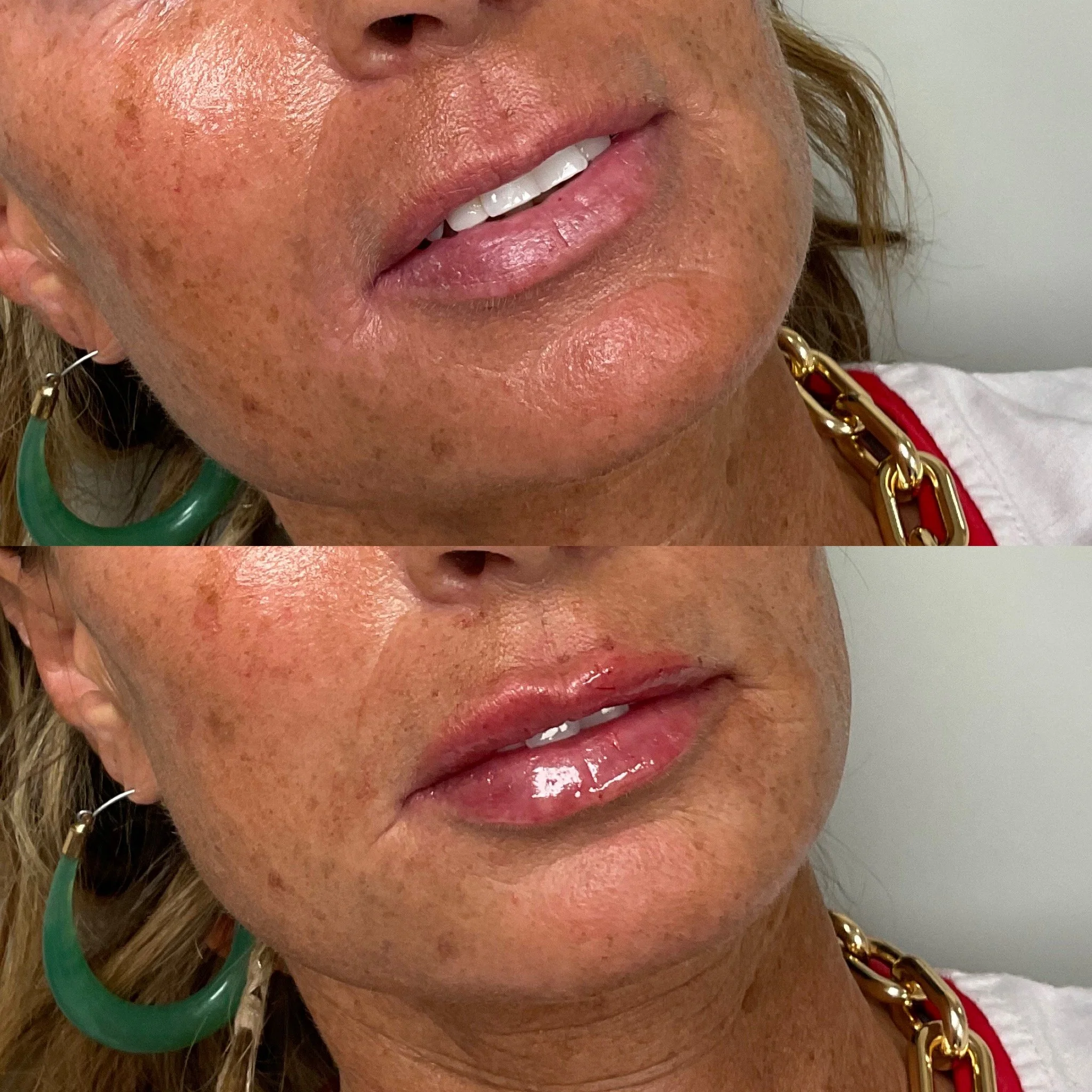 Close-up of a woman's lower face showing lips, chin, and part of the cheek with areas of redness and visible skin texture, including freckles and pores.
