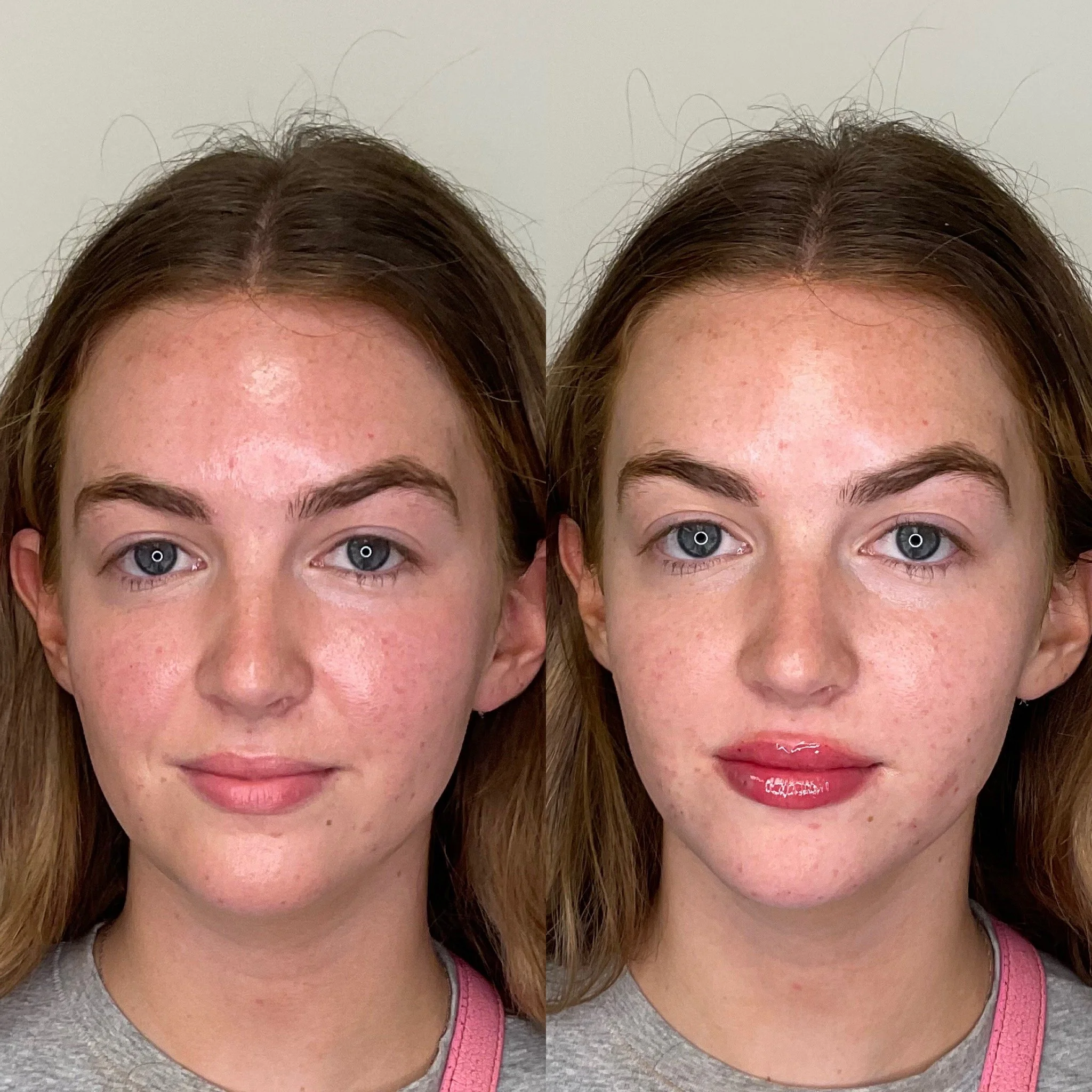A side-by-side comparison of a woman's forehead and eyebrows, showing improvement in skin texture and redness.