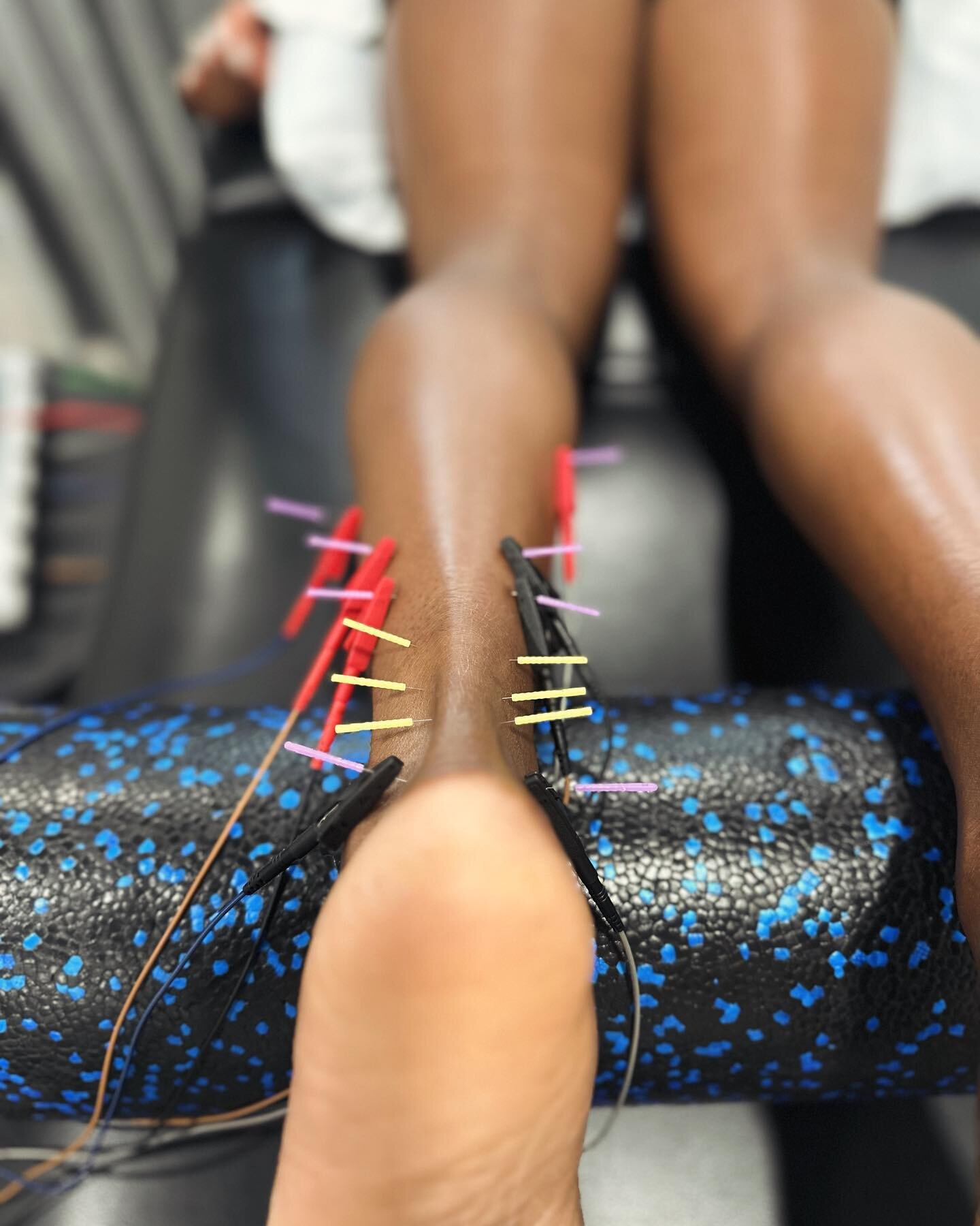 Discover the Power of Dry Needling for Tendonitis &amp; Chronic Inflammation Relief! 🌟

Struggling with tendonitis or chronic inflammation? Dry needling might be your game-changer! 💪 Here&rsquo;s why:

1️⃣ Targeted Relief: Dry needling precisely ta