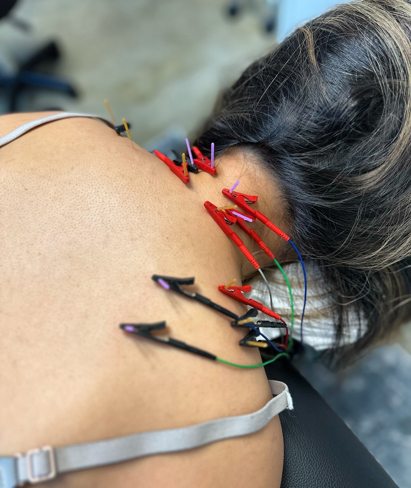 Neck &amp; Shoulder - Release Those Knots 🪡🪢

Dry Needling targets those hard, tense knots in the deep tissue that can cause pain, stiffness, and even headaches 🤕

We specialize in dry needling and produce effective results, with some patients ach