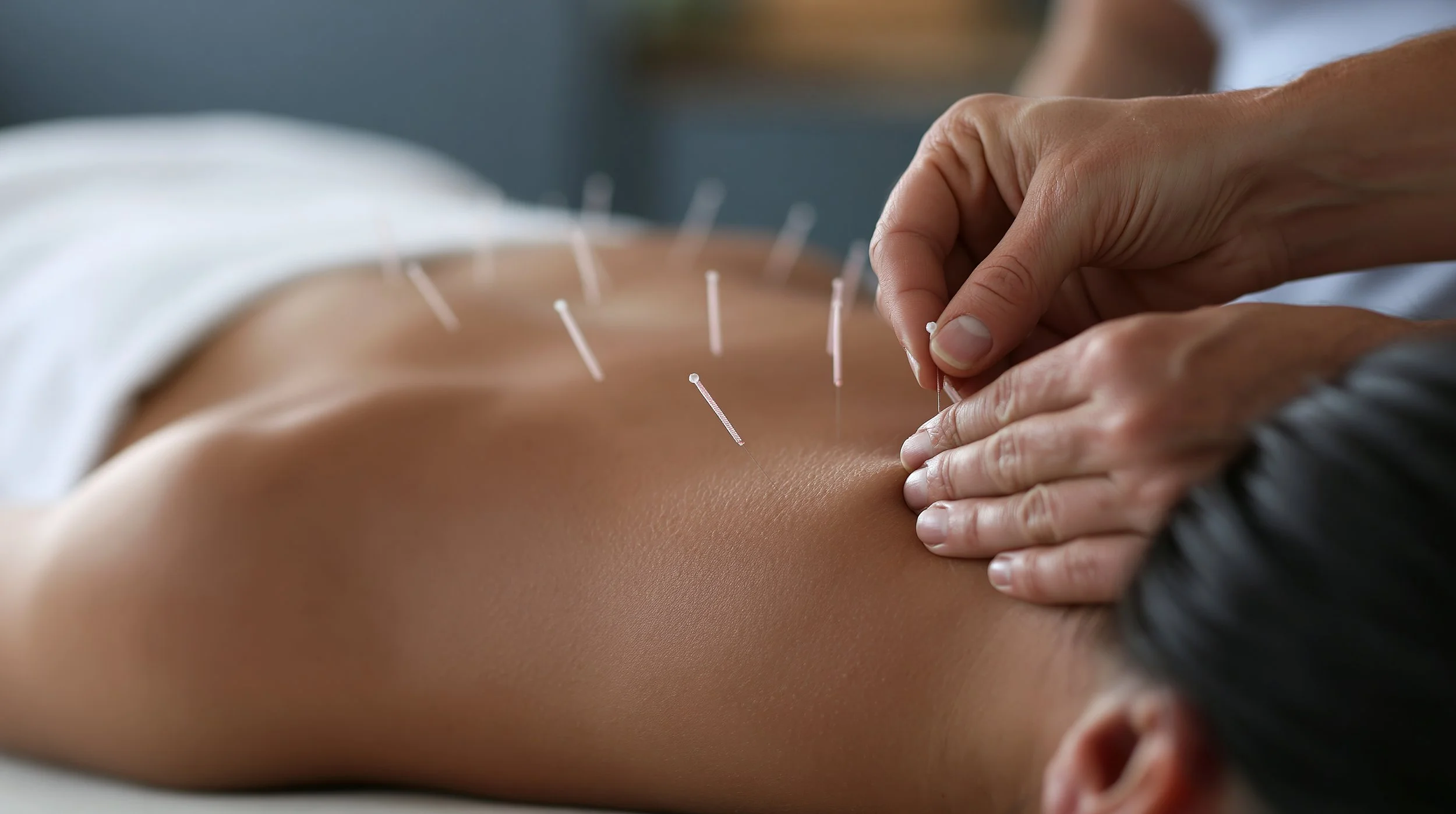 Acupuncture in Atlanta, Buckhead: Your Complete Guide to Stress, Pain &amp; Wellness Relief