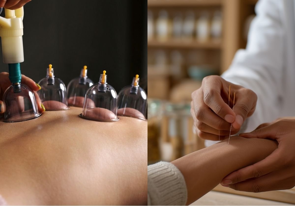 Cupping Therapy vs Acupuncture: Which One Is Right for You?