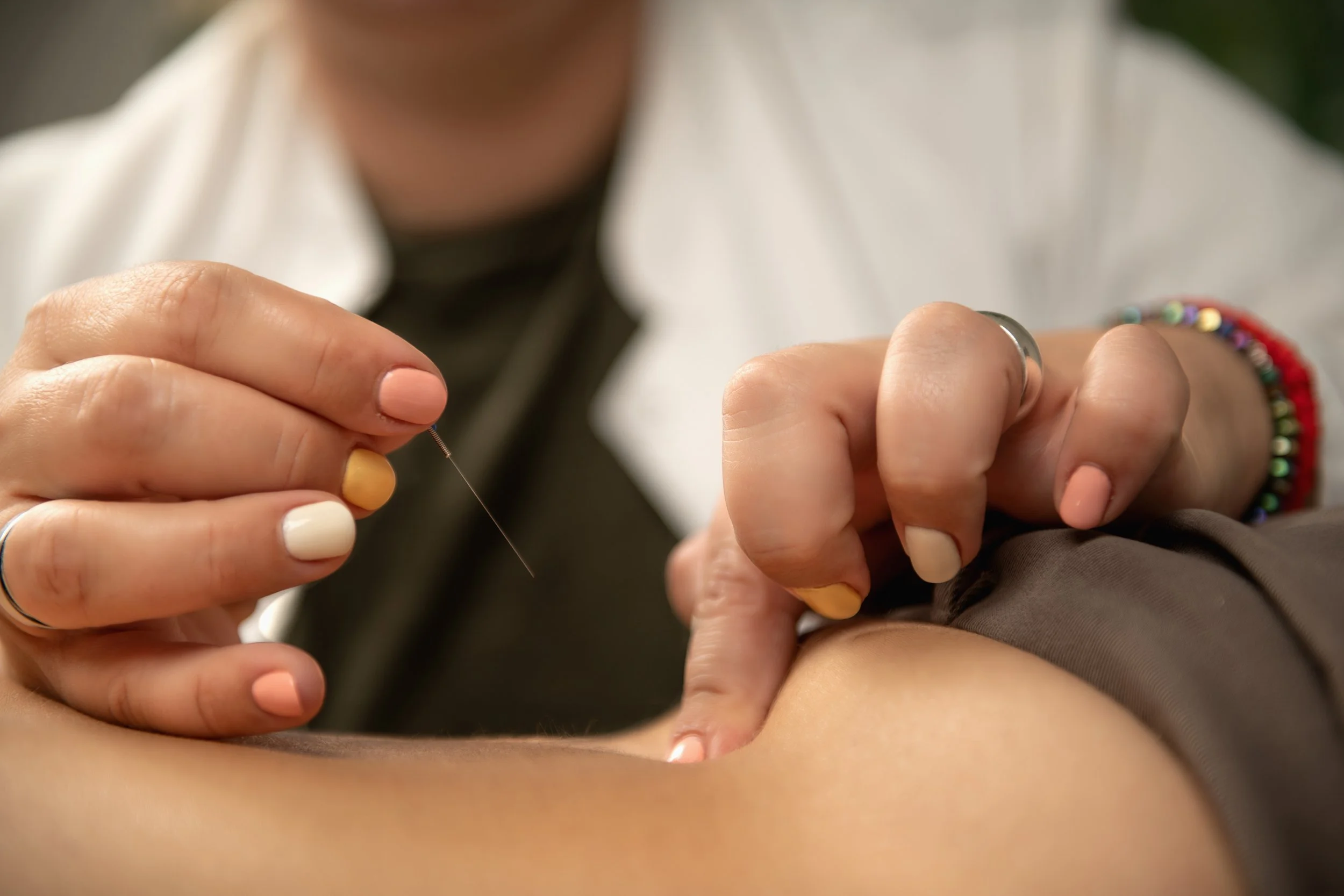 Acupuncture for Sciatica Nerve