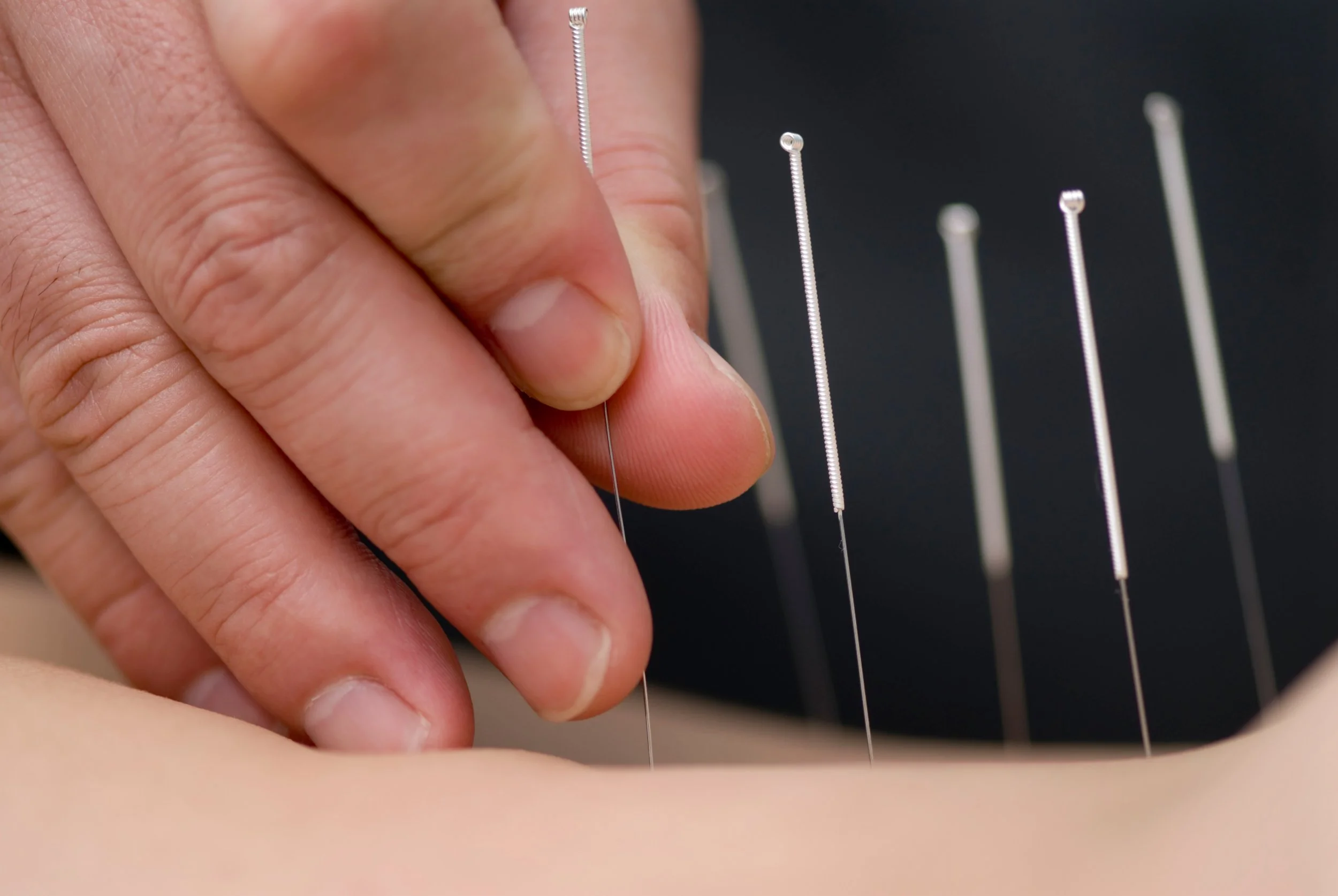 Acupuncture and Overall Wellness