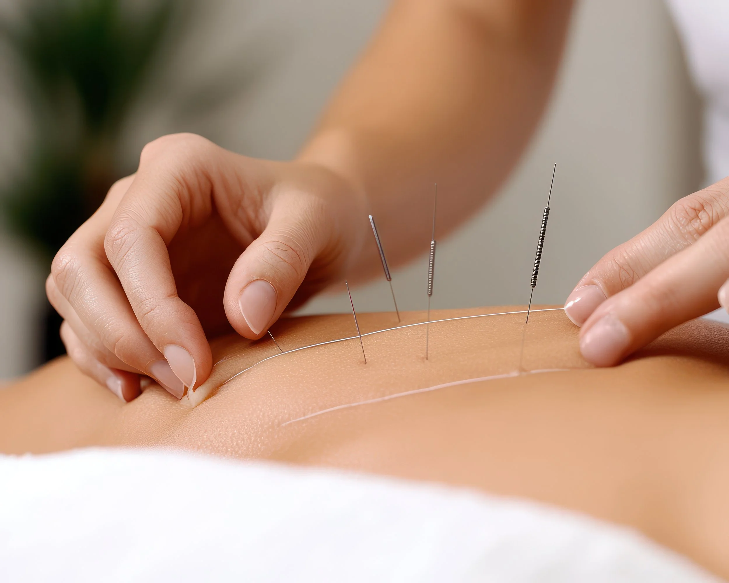Acupuncture for Sleeplessness