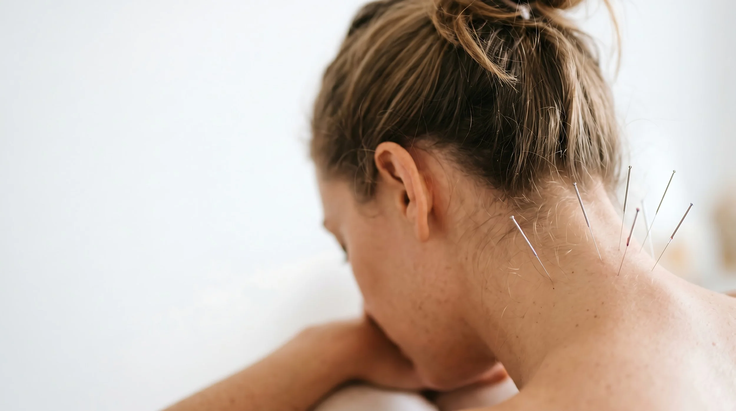 Acupuncture for Neck pain