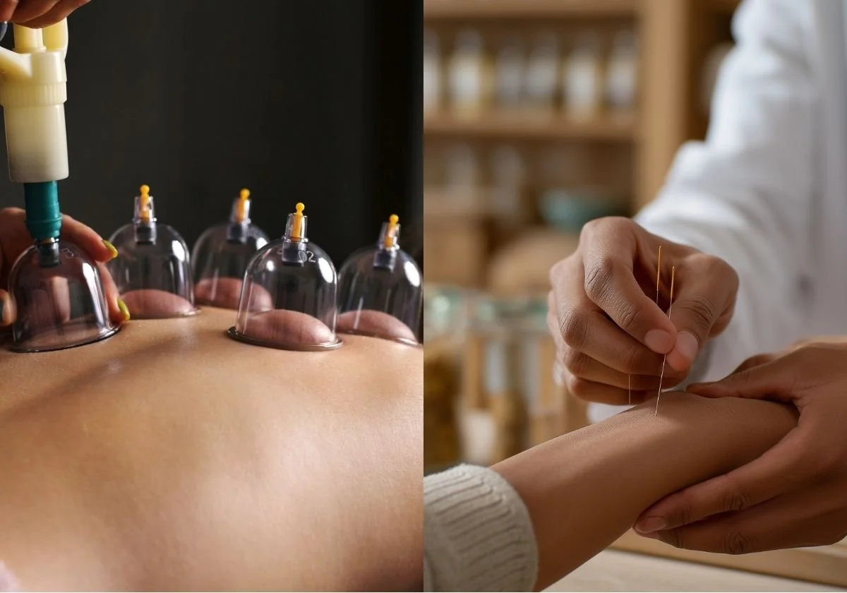 cupping therapy vs acupuncture