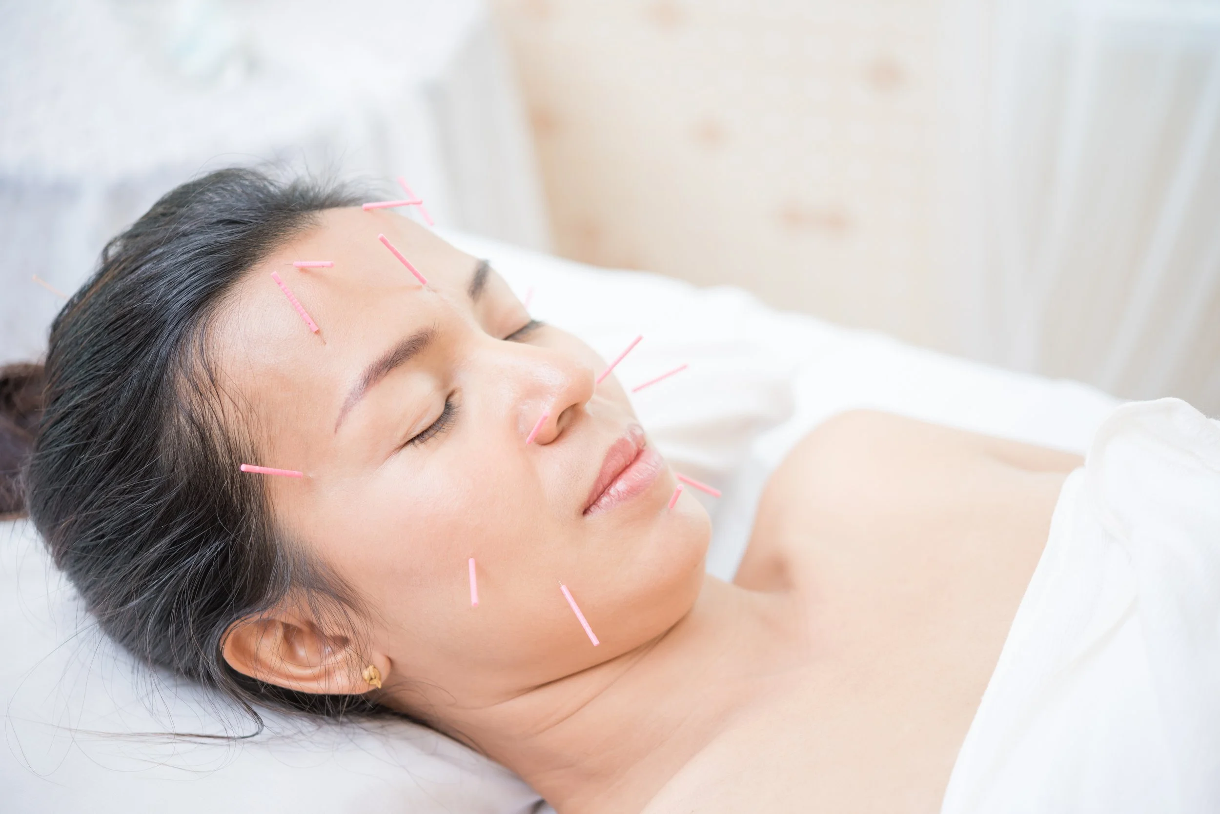 Facial Acupuncture