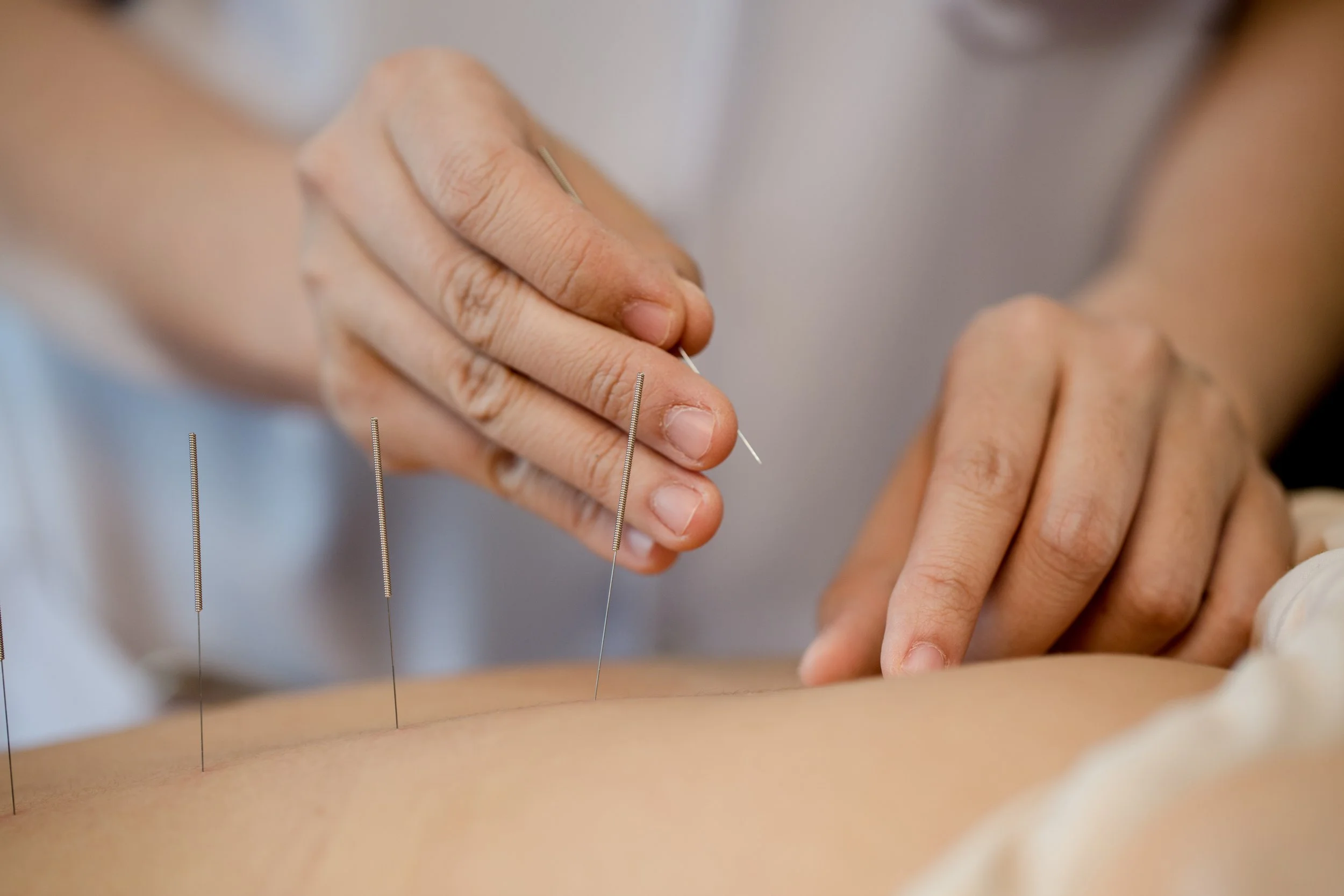 Acupuncture for stress