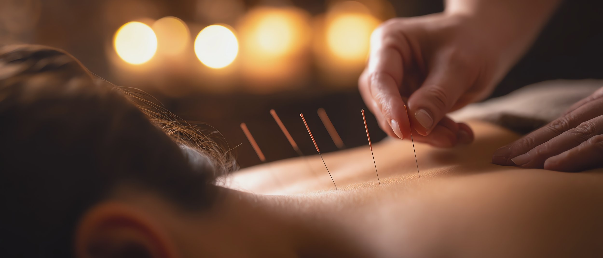 acupuncture session