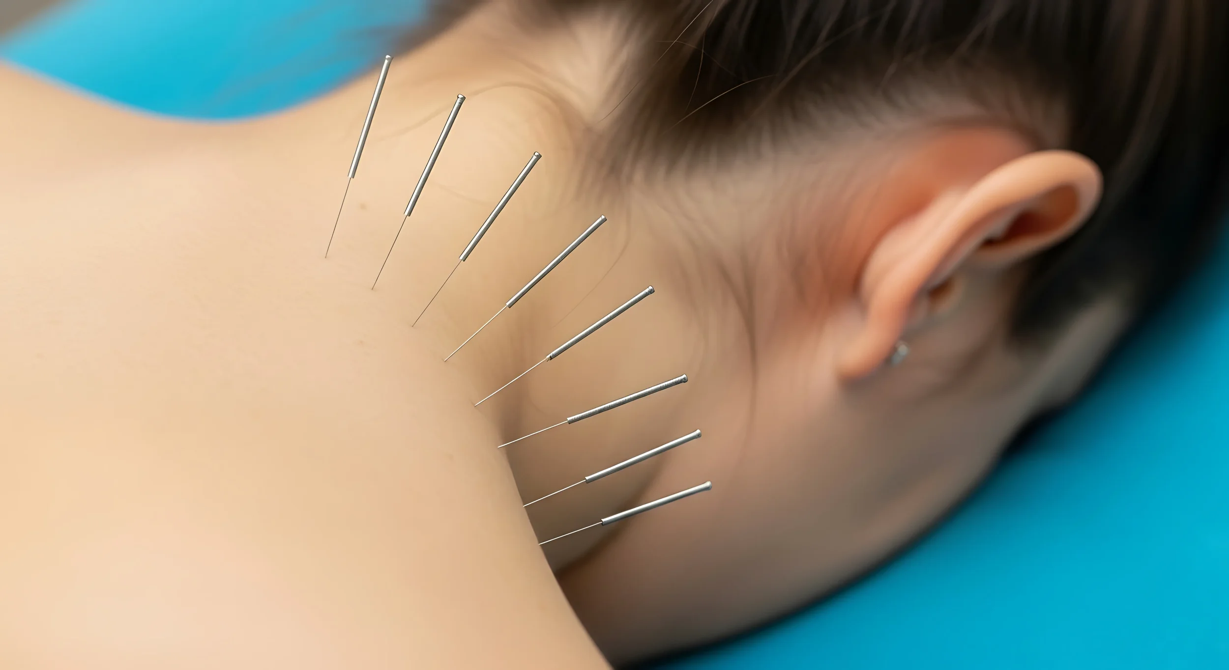 Acupuncture for Neck pain