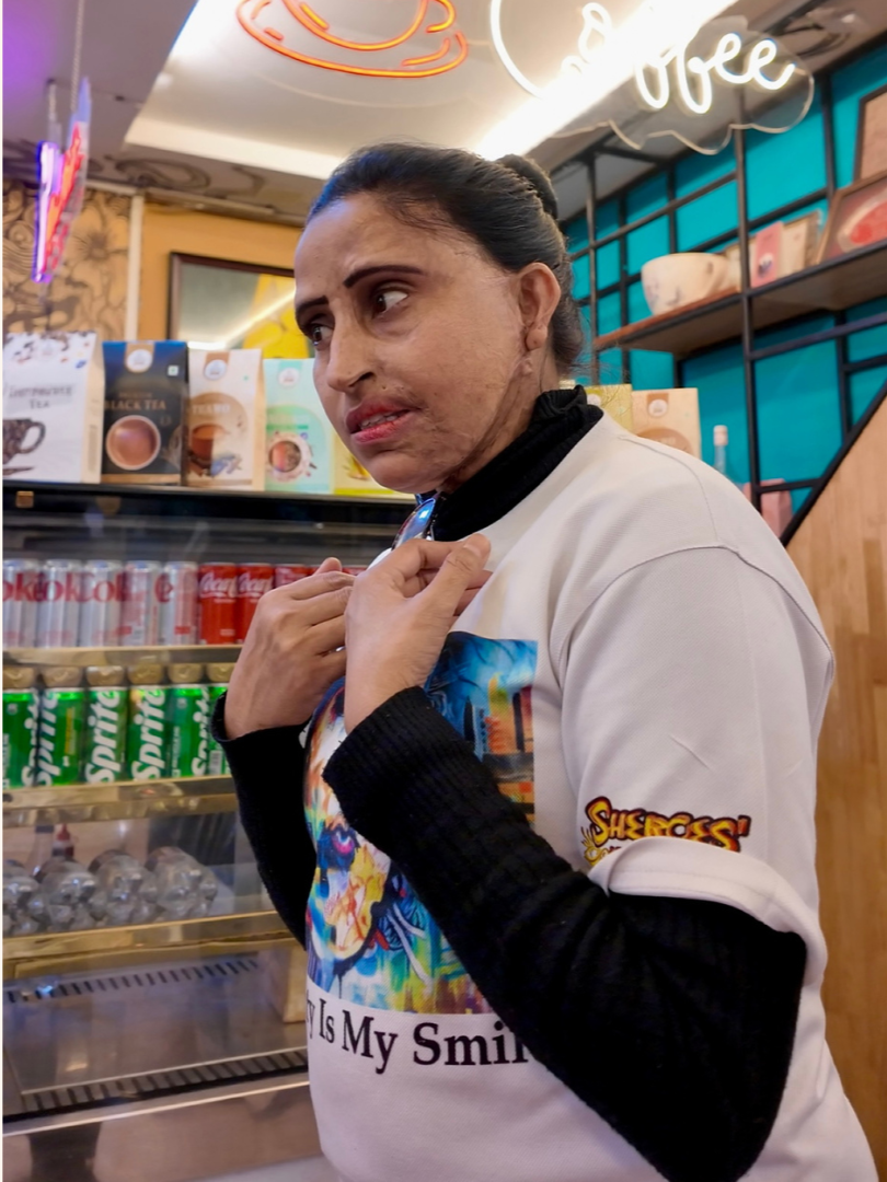 Acid attack survivor woman sharing her story