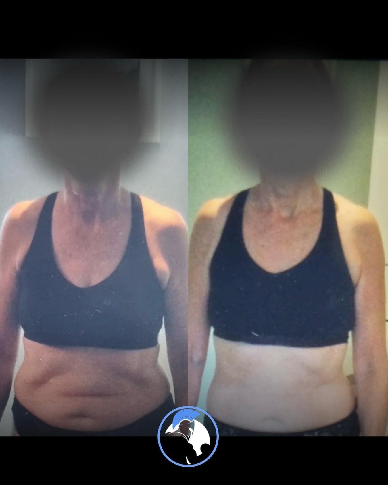 A nice tidy up for another client here! 🚨

You won&rsquo;t believe it but SAME WEIGHT in both pictures!!

Scale weight isn&rsquo;t everything, it&rsquo;s only 1 tool out of many to see if you&rsquo;re on track or not

This was simple:

✅ First we cr