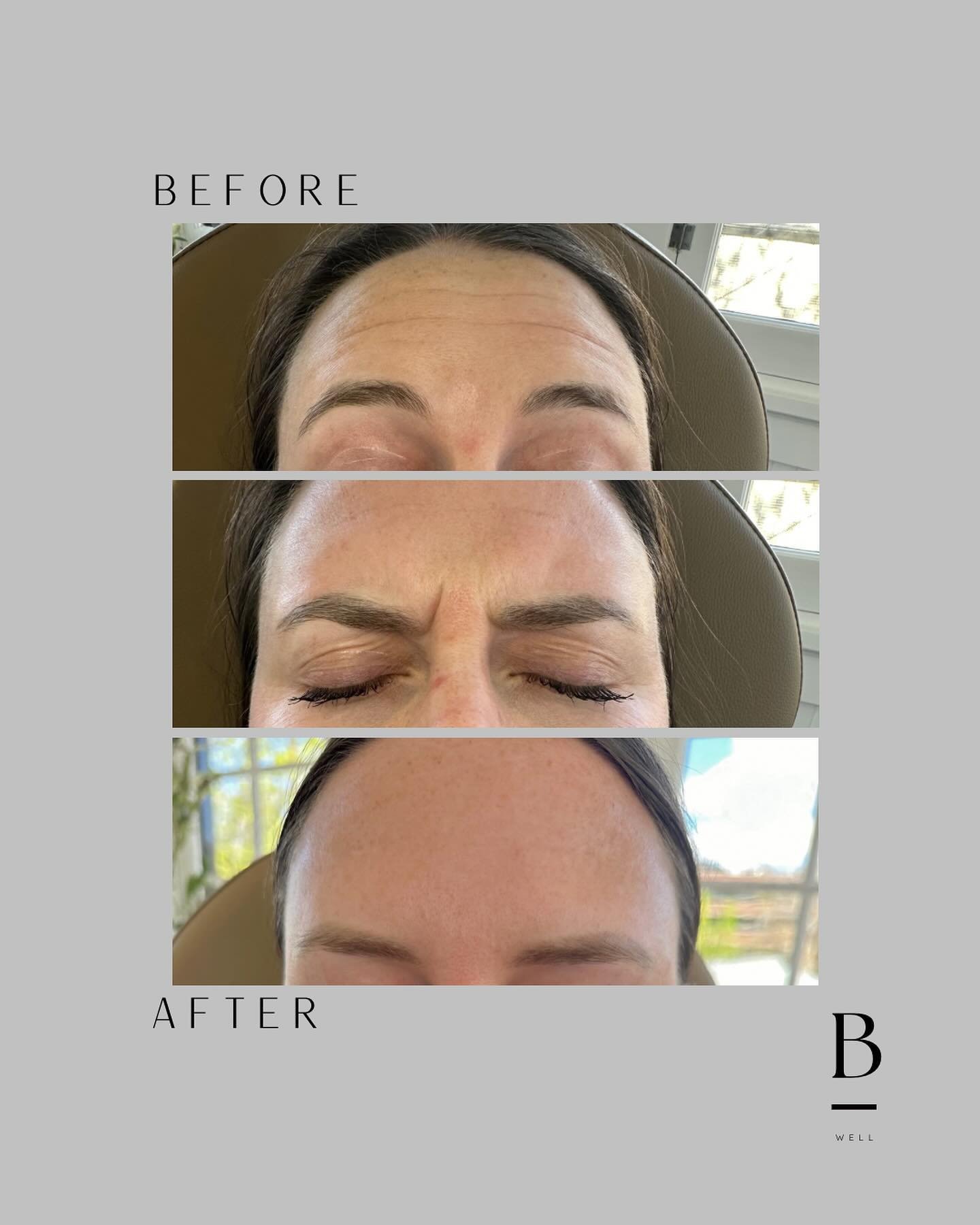 Unlock the power of subtle transformations! 💫✨ Swipe to see the magic of DAXXIFY&trade;️, one of the 3 neurotoxin options at Bloom Women&rsquo;s Health. Enhance your natural beauty with precision and holistic tox treatments for a glow that radiates 