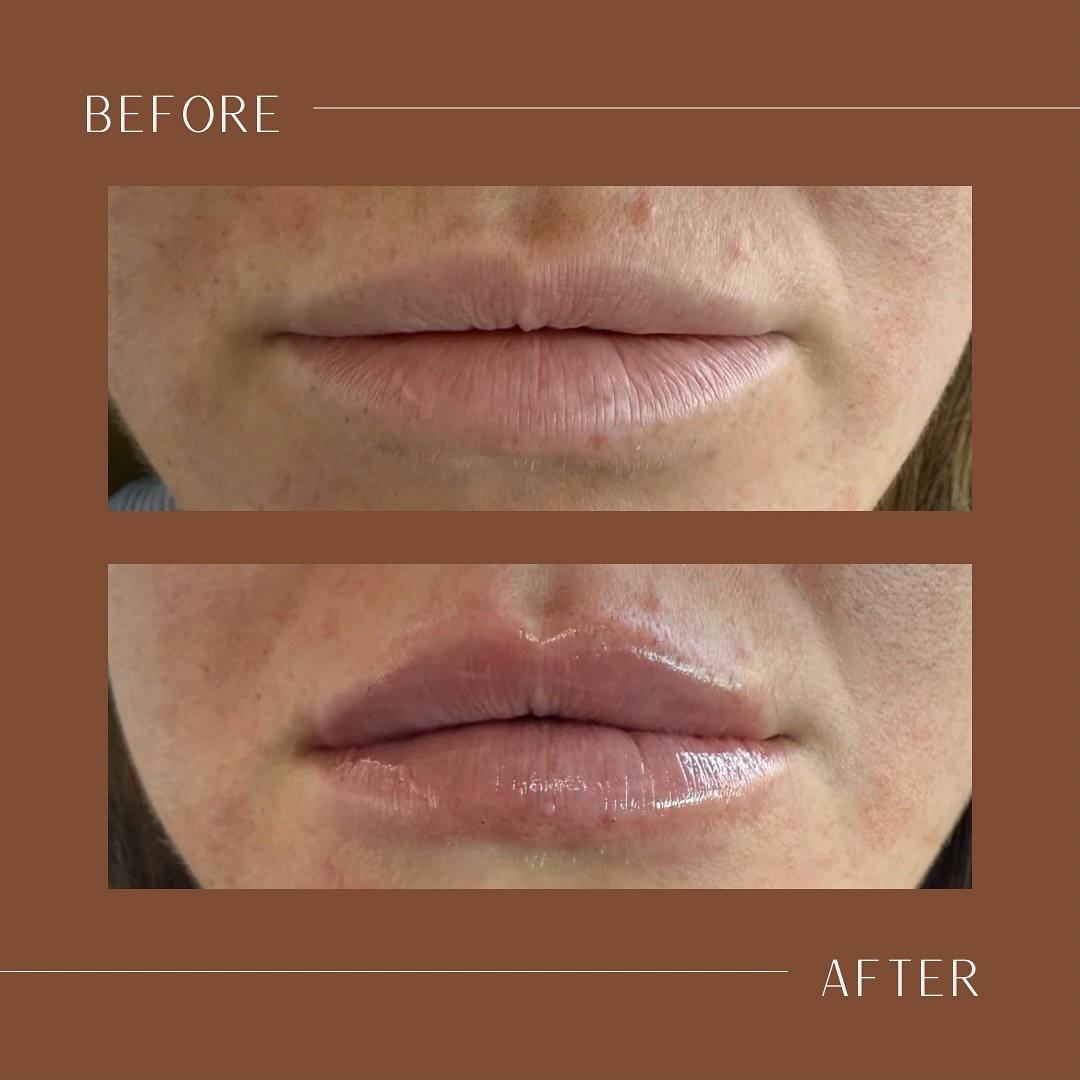 ✨ Subtle. Beautiful. Confident. ✨ 

At Bloom Women&rsquo;s Health, we believe in enhancing your natural beauty with a holistic approach to aesthetics. These stunning lip filler results showcase how small, intentional changes can create a balanced and