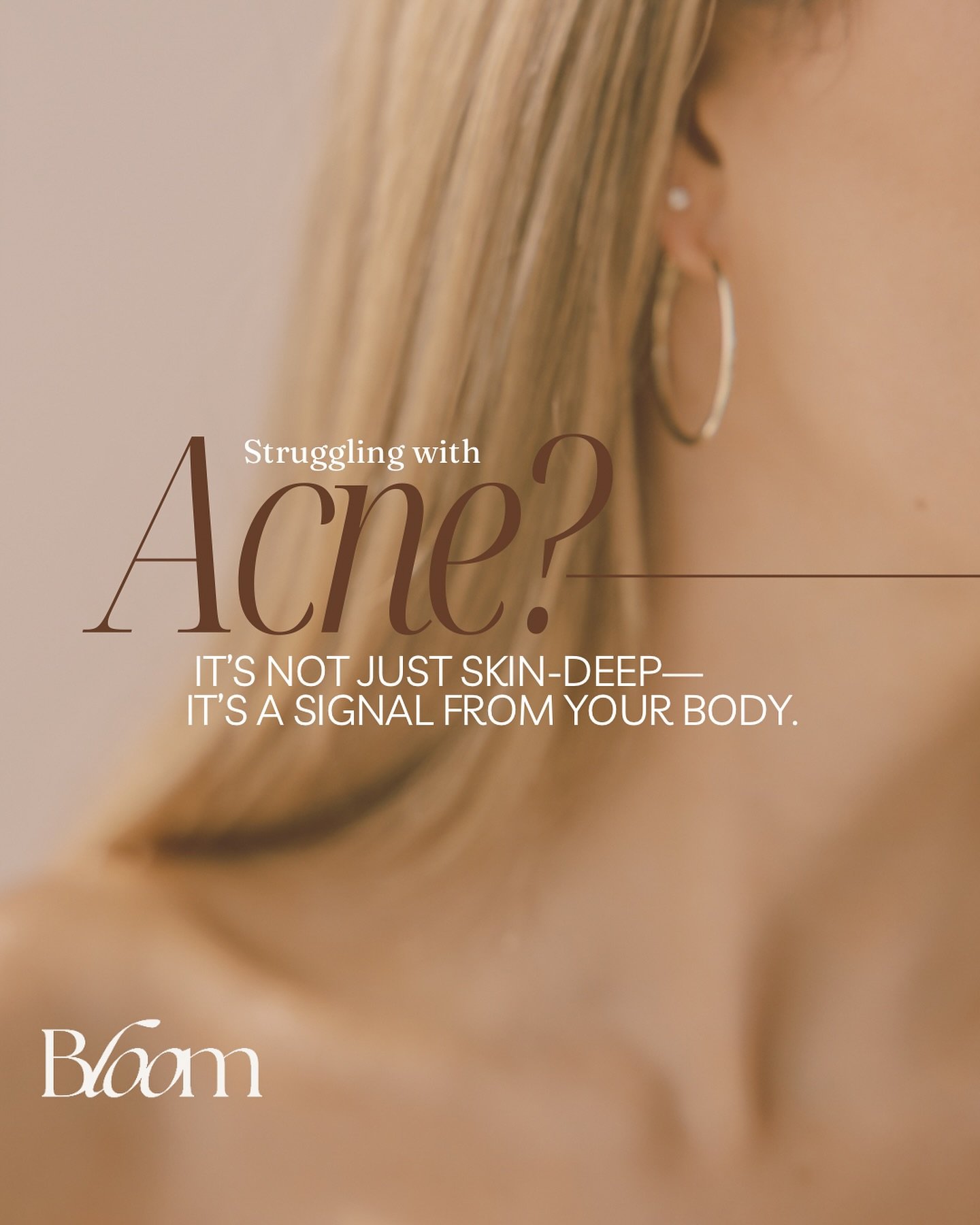 Acne isn&rsquo;t just about what&rsquo;s on your skin&mdash;it&rsquo;s a message from within. 

At Bloom, our approach to acne is comprehensive and customized, starting with understanding your unique body, hormones, and lifestyle. Through advanced te