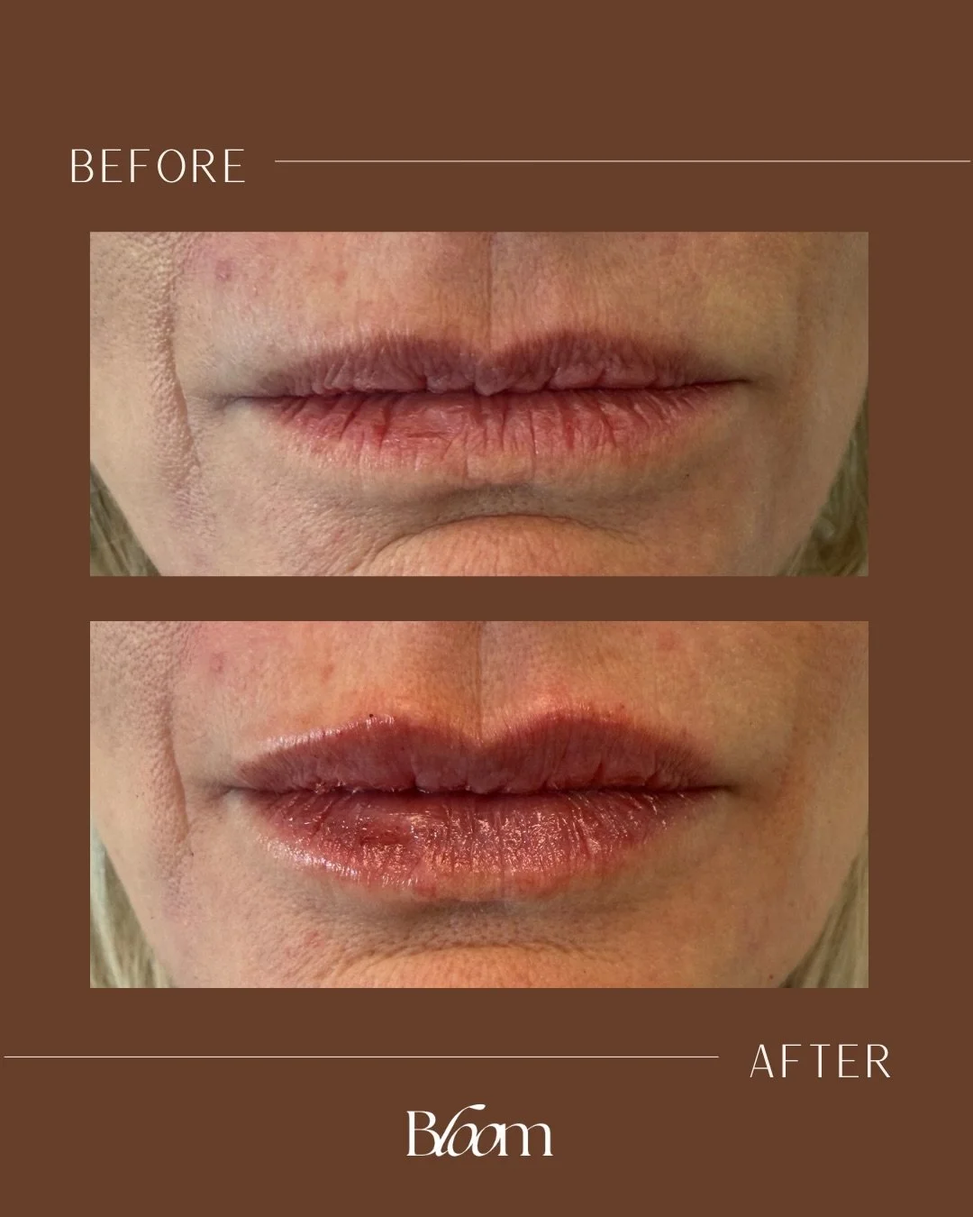 Lip filler doesn&rsquo;t mean bigger. It means balanced, hydrated, and proportionate 💉✨

At Bloom, we focus on enhancing natural lip shape, restoring subtle volume, and maintaining harmony with the rest of your face. Every treatment is customized to