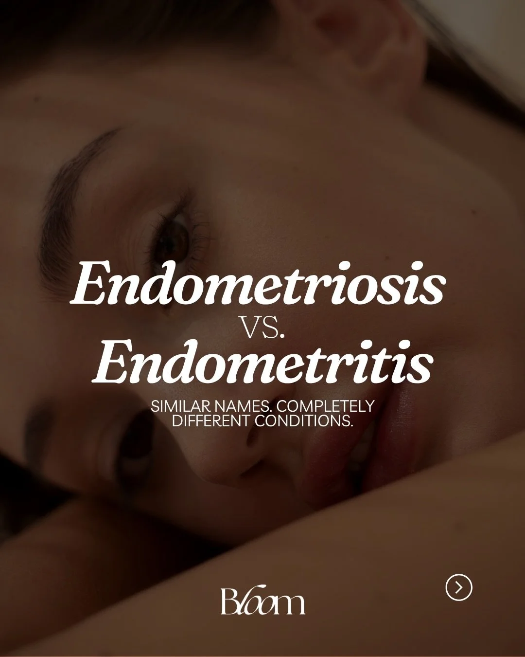 Endometriosis and endometritis are often confused&mdash;but they are NOT the same thing.

One is a chronic inflammatory condition where tissue grows outside the uterus.
The other is inflammation inside the uterus, often driven by infection.

Both can