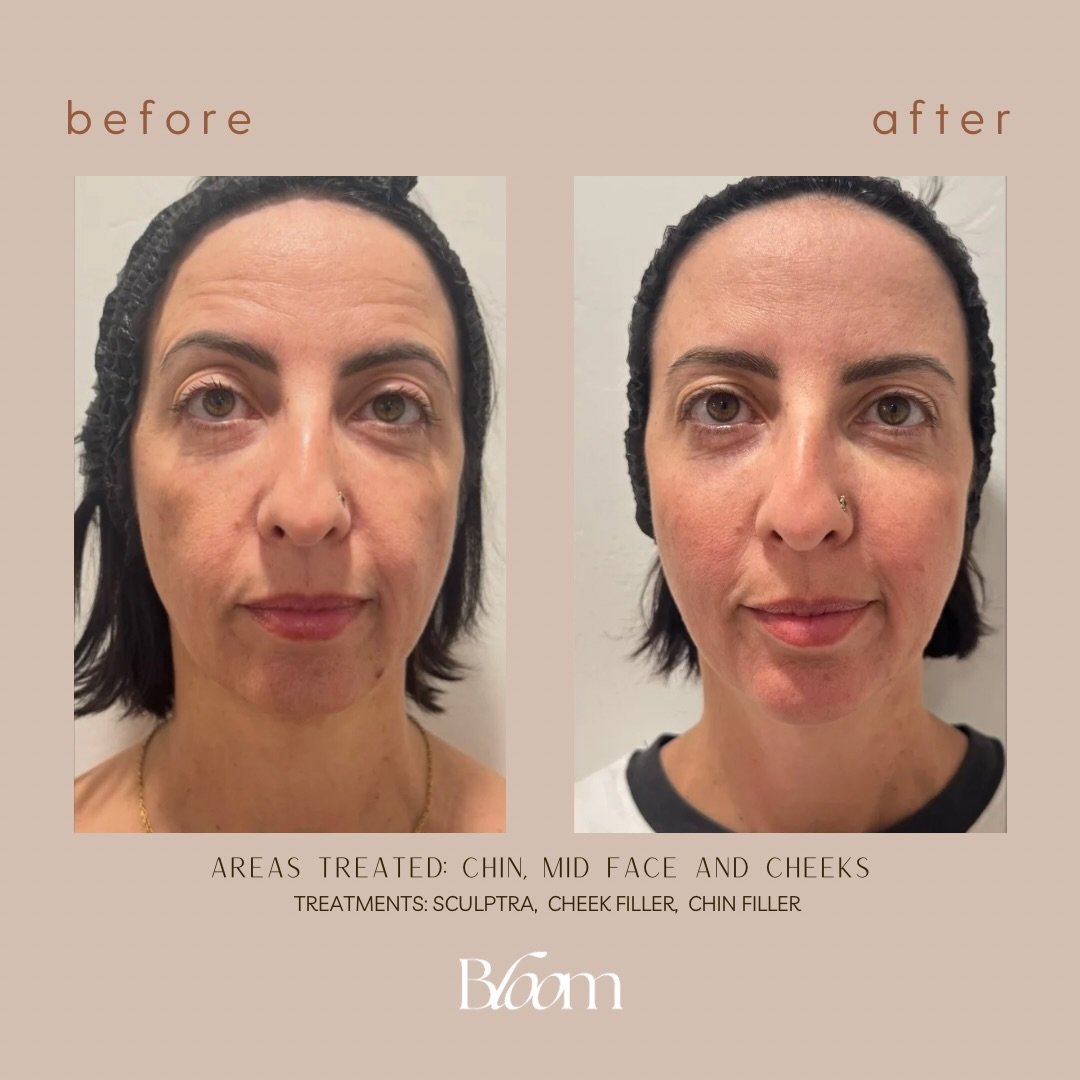 True facial balancing happens when we step back and evaluate the face as a whole. Often, the concern someone notices first isn&rsquo;t actually where the underlying loss of support is occurring. By restoring structure strategically throughout the fac