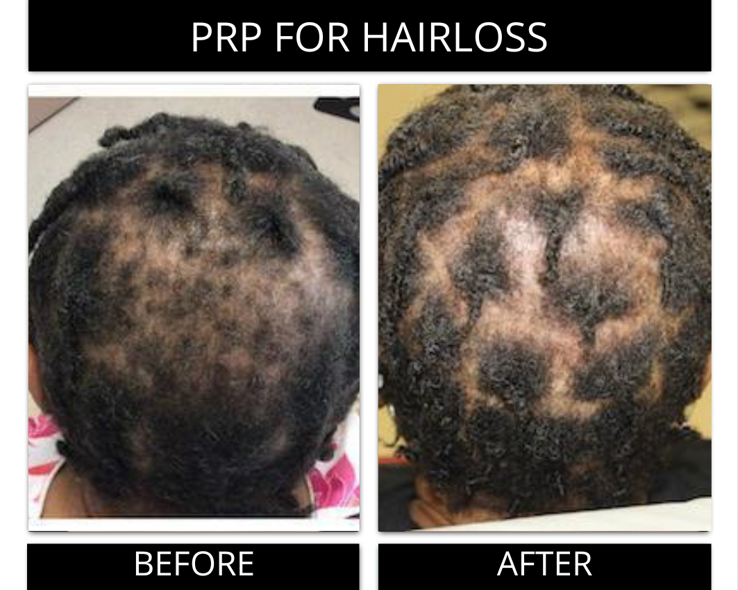 hair loss gambrills (2).png