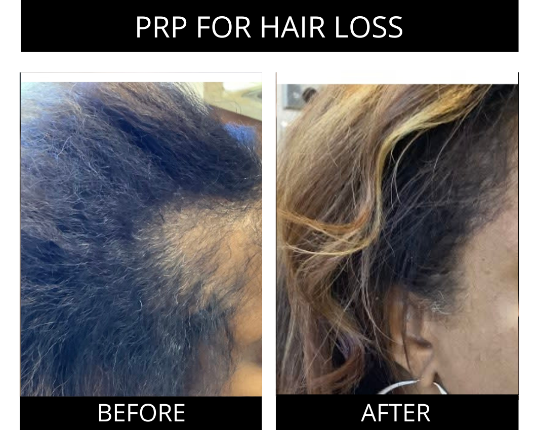 PRP FOR HAIRLOSS GAMBRILLS MD.png