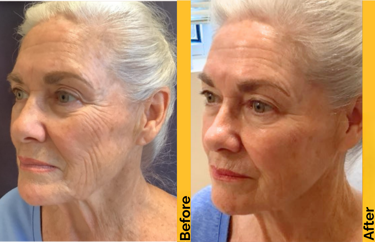 ULTHERAPY PRIME BEFORE AND AFTER (2).png