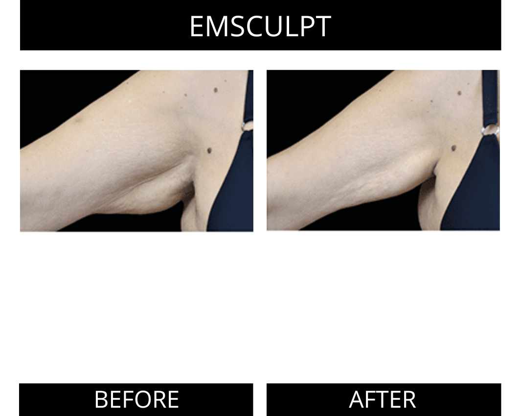 Body Contouring Results