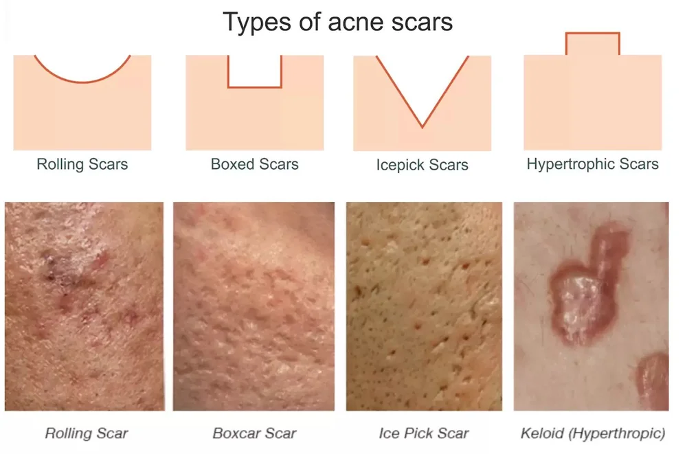 Splinter Like Acne Acne Treatment | Gambrills MD