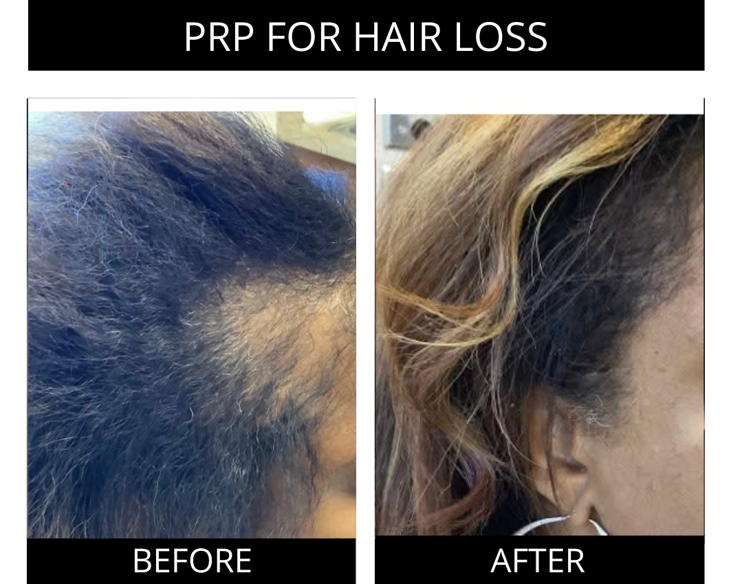 Hair Restoration Results