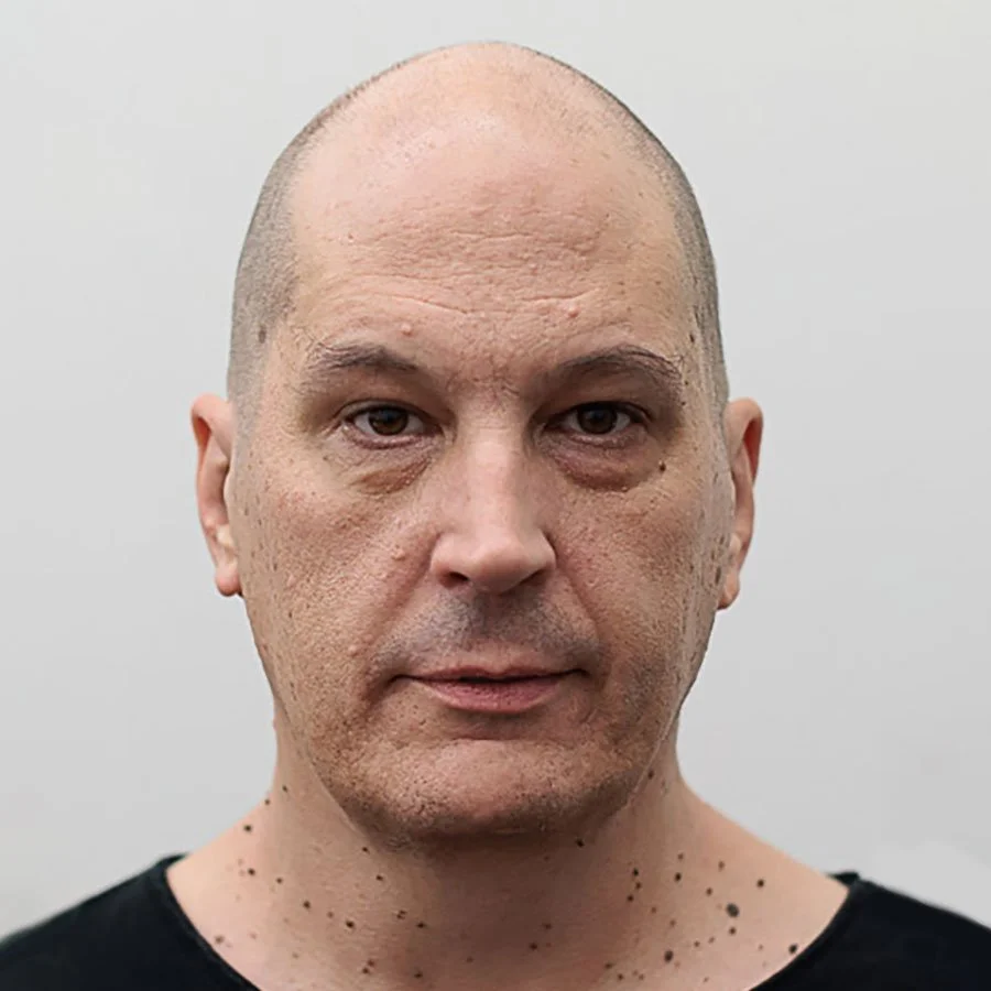 A close-up photo of a bald man with light skin, slight facial blemishes, and wearing a black shirt