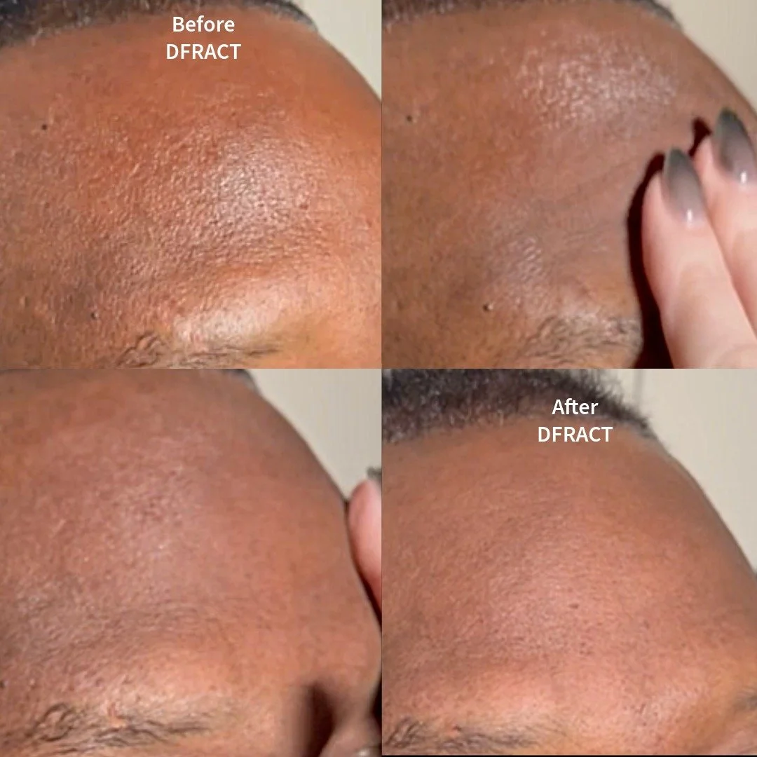 A before and after photo of a translucent cream being applied to dark skin and the pore minimizing, texture refining, anti-shine effect it has thanks to DFRACT Blur Balm invisible