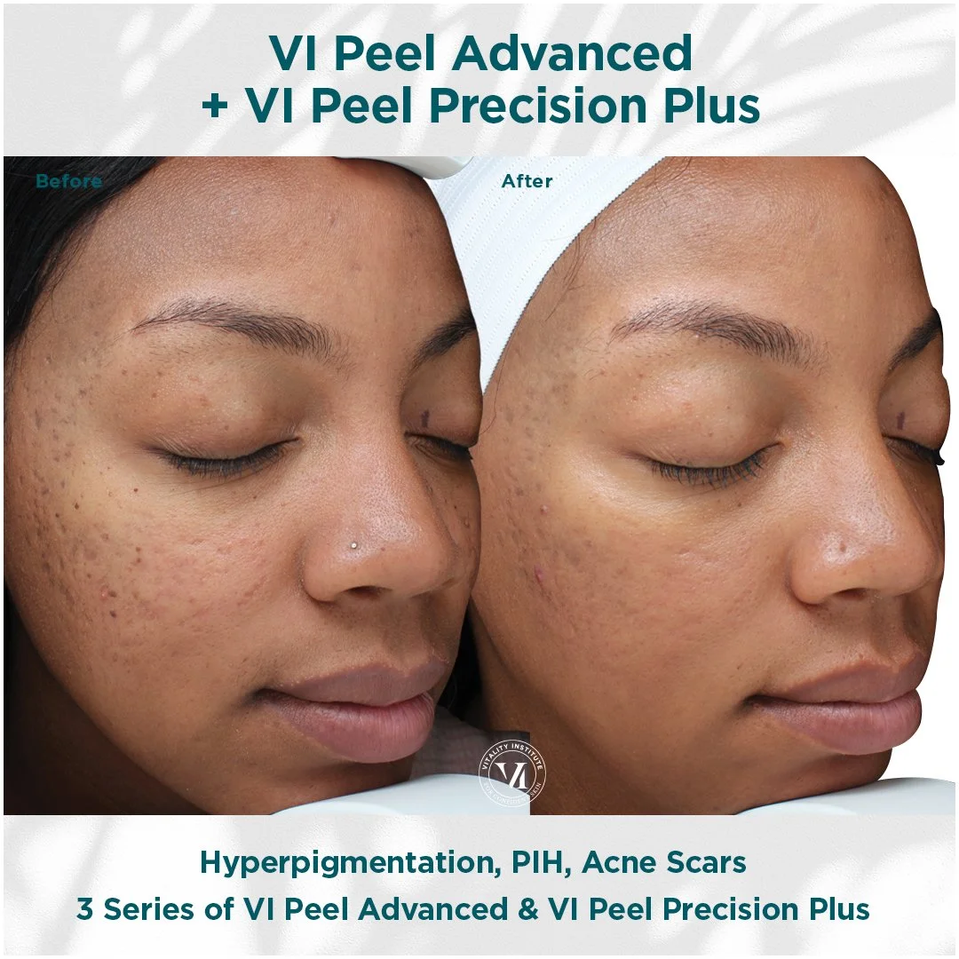 Before and after images showcasing the results of a VI Peel Advanced and VI Peel Precision Plus treatment on a woman's face, targeting hyperpigmentation, post-inflammatory hyperpigmentation, and acne scars. Text indicates three series of treatments.