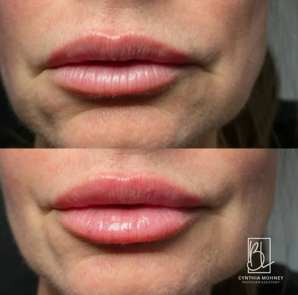 Before and after images showing lip enhancement treatment results.