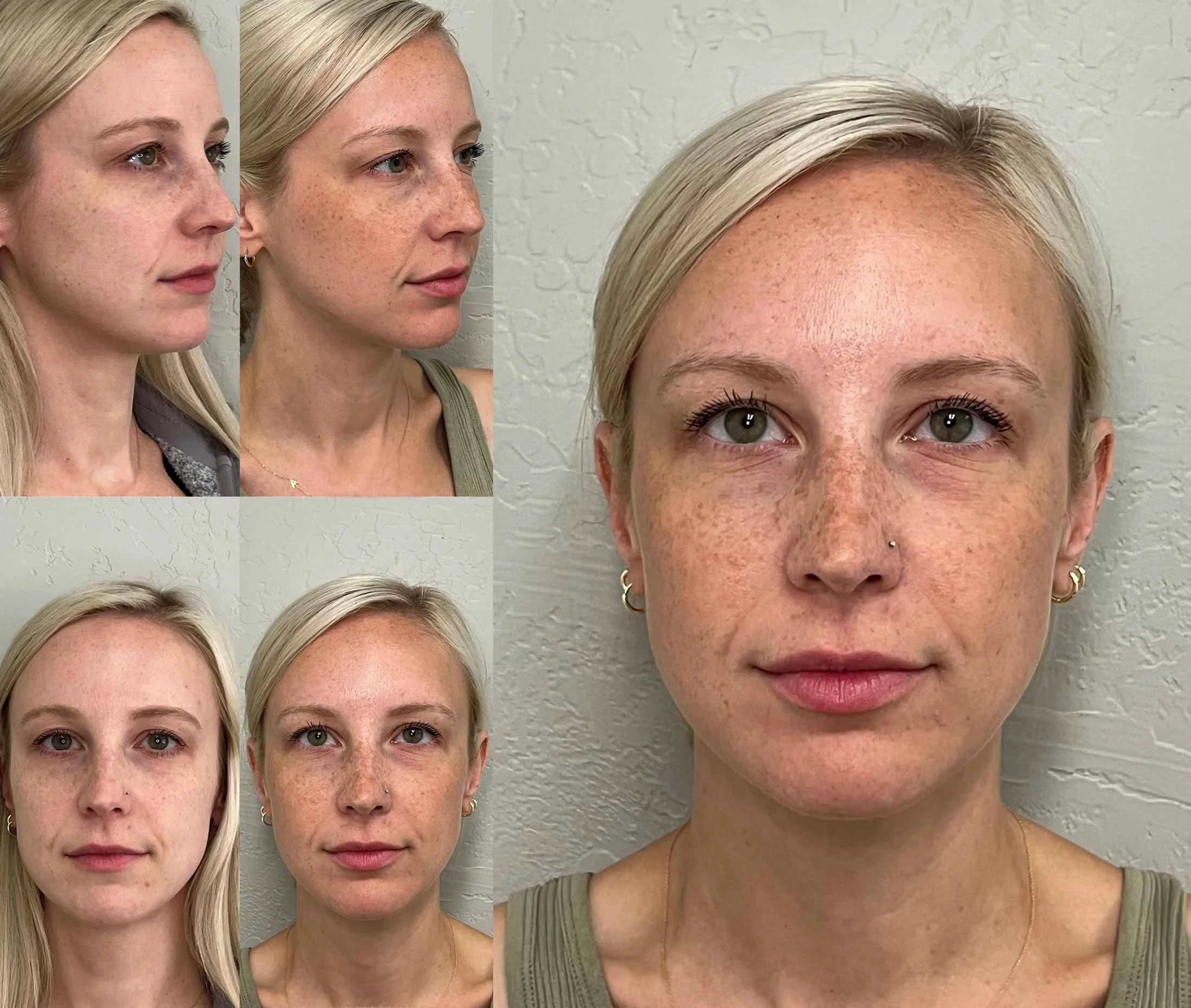 Sculptra in Chico, CA - Restore Facial Volume, Collagen