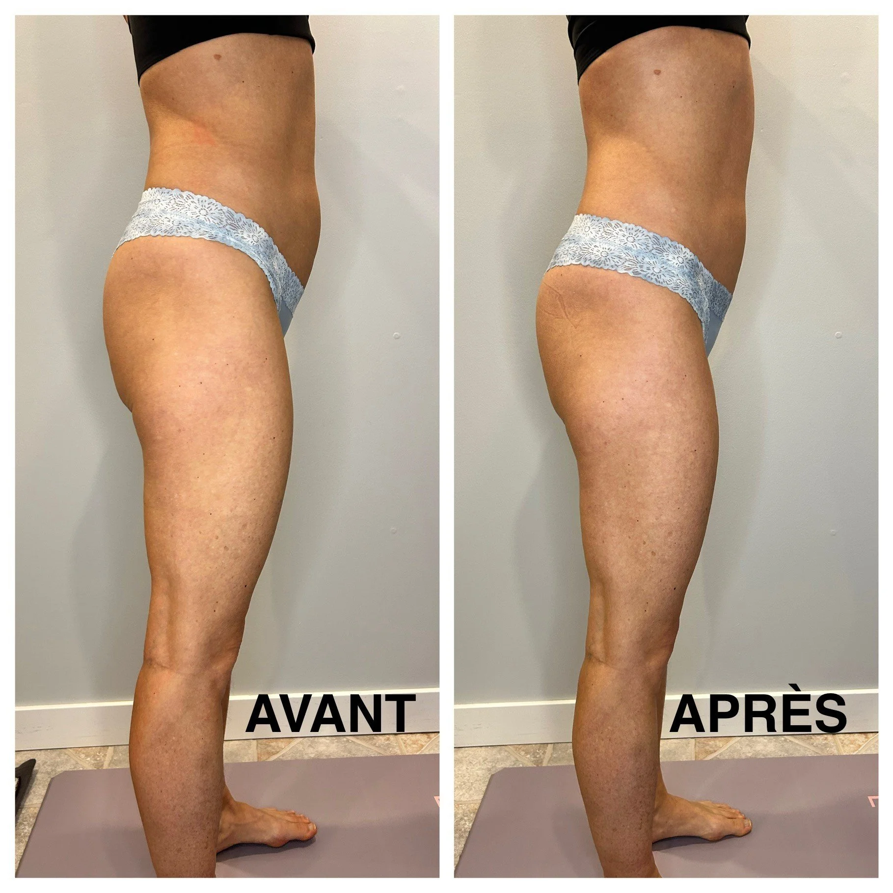 MC_Remodelage-Abdomen-Côté.jpg